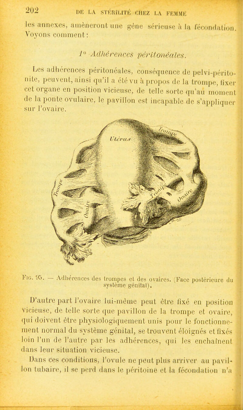 20-2 DU L\ srr.RiLiTii chez l\ fkmme les annexes, amèneront une gène sérieuse à la féconHalion. Voyons comment : Adhérences pé7Hionéales. Les adhérences péritonéales, conséquence de pelvi-périto- nile, peuvent, ainsi qu'il a été vu à propos de la trompe, fixei- cet organe en position vicieuse, de telle sorte qu'au moment de la ponte ovulaire, le pavillon est incapable de s'appliquer sur l'ovaire. FiG. 95. — Adhérences des trompes el des ovaii-es. (Face postérieure du système génital). D'autre part l'ovaire lui-même peut être fixé en position vicieuse, de telle sorte que pavillon de la trompe et ovaire, qui doivent être physiologiquement unis pour le fonctionne- ment normal du système génital, se trouvent éloignés et fixés loin l'un de l'autre par les adhérences, qui les enchaînent dans leur situation vicieuse. Dans Ces conditions, Tovule ne peut plus arriver au pavil- lon tubaire, il se perd dans le péritoine el la fécondation n'a