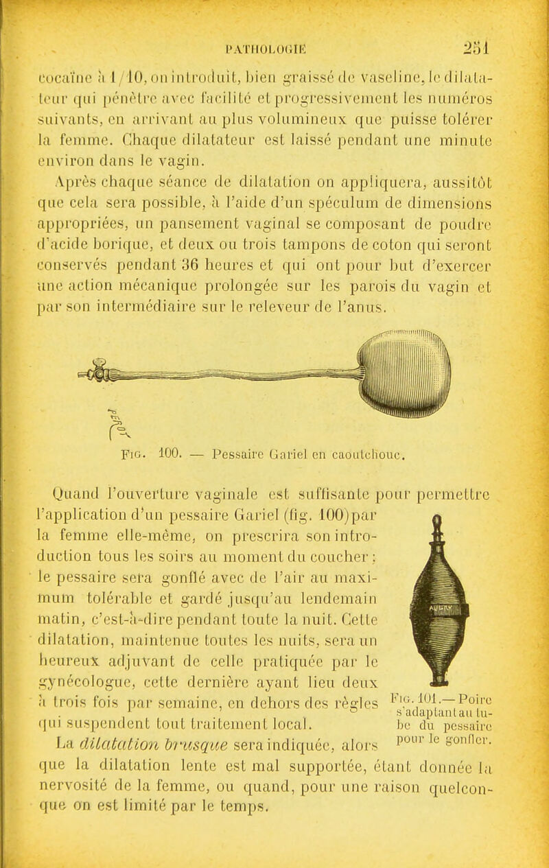 l'ATIIOLOdlK eucciïiio à 1/10, on inlroiiiiit, bien graissé de vaseline, le dilala- lour qui [)énèlre a^•oc raciliLc cl progressivement les numéros suivants, en arrivant au jjliis volumineux que puisse tolérer la femme. Chaque dilatateur est laissé pendant une minute environ dans le vagin. Après chaque séance de dilatation on appliquera, aussitôt que cela sera possible, à l'aide d'un spéculum de dimensions appropriées, un pansement vaginal se composant de poudre d'acide borique, et deux ou trois tampons de coton qui seront conservés pendant 36 heures et qui ont pour but d'exercer une action mécanique prolongée sur les parois du vagin et par son intermédiaire sur le releveur de l'anus. ^^.r'iiniiiiiirl(||nr. Fio. 100. — Pessaire Gariel en caoLiLcliouc. (Juand l'ouverture vaginale est suffisante pour permettre l'application d'un pessaire Gariel (fig. lOOjpar la femme elle-même, on prescrira son intro- duction tous les soirs au moment du coucher ; le pessaire sera gonflé avec de l'air au maxi- mum tolérable et gardé jusqu'au lendemain matin, c'est-à-dire pendant toute la nuit. Cette dilatation, maintenue toutes les nuits, sera un heureux adjuvant de celle pratiquée par le gynécologue, cette dernière ayant lieu deux h trois fois par semaine, en dehors des règles qui suspendent tout traitement local. La dilatation hi'usqae sera indiquée, alors que la dilatation lente est mal supportée, étant donnée la nervosité de la femme, ou quand, pour une raison quelcon- que an est limité par le temps. Fig. lui .— Poire s'adaplaiilau lu- be du pessaire pour le gonfler.