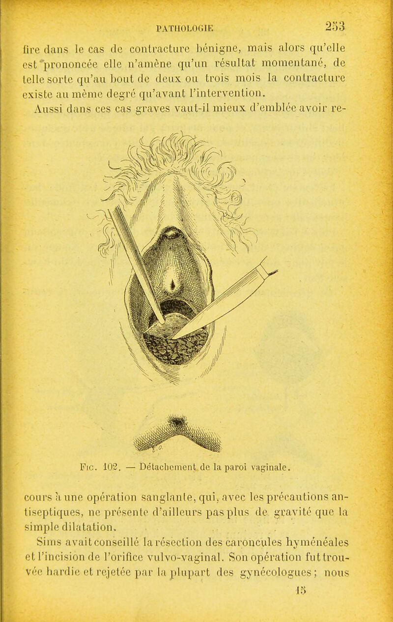 PATHOLOGIE 233 fire dans le cas tic contracture bénigne, mais alors qu'elle est prononcée elle n'amène qu'un résul tat momentané, de telle sorte qu'au bout de deux ou trois mois la contracture existe au même degré qu'avant l'intervention. Aussi dans ces cas graves vaut-il mieux d'emblée avoir re- Fic. 102. — Détachement de la paroi vaginale. cours à une opération sanglante, qui, avec les précautions an- tiseptiques, ne présente d'ailleurs pas plus de gravité que la simple dilatation. Sinis avaitconseillé laréscction des caroncules hyménéales et l'incision de l'orifice vulvo-vaginal. Son opération futtrou- vée hardie et rejetée par la plupart des gynécologues; nous J5