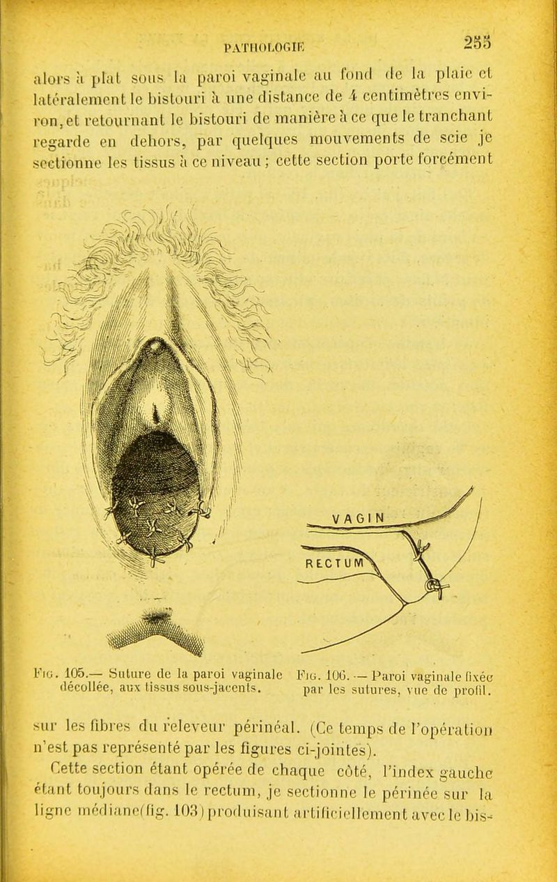 alors II plat sous la paroi vaginale au fond de la plaie cL latéralement le bistouri à une distance de 4 centimètres envi- ron, et retournant le bistouri de manière h ce que le tranchant regarde en dehors, par quelques mouvements de scie je sectionne les tissus à ce niveau; cette section porte forcément Fuj. 105.— yuture tic la paroi vaginale Fm. lOG. — Paroi vaginale (ixée décollée, aux lissus sous-jaccnts. par les sutures, vue de profil. sur les fibres du releveur périnéal. (Ce temps de l'opération n'est pas représenté par les figures ci-jointes). Cette section étant opérée de chaque coté, l'index gauche étant toujours dans le rectum, je sectionne le périnée sur la ligne médiancCfig. 103 ) produisant artificiellement avec le bis-