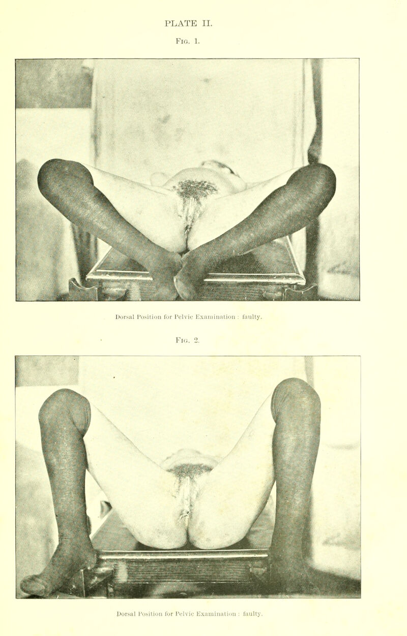 PLATE II. Fig. 1. Dorsal Position for Pelvic Examination : faulty