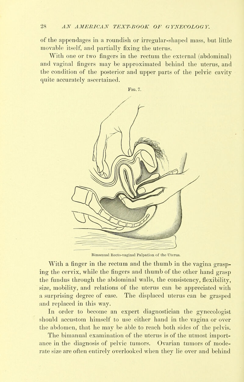 of the appendages in a roundish or irregular-shaped mass, but little movable itself, and partially fixing the uterus. With one or two fingers in the rectum the external (abdominal) and vaginal fingers may be approximated behind the uterus, and the condition of the posterior and upper parts of the pelvic cavity quite accurately ascertained. Fig. 7. Bimanual Recto-vaginal Palpation of the Uterus. With a finger in the rectum and the thumb in the vagina grasp- ing the cervix, while the fingers and thumb of the other hand grasp the fundus through the abdominal walls, the consistency, flexibility, size, mobility, and relations of the uterus can be appreciated with a surprising degree of ease. The displaced uterus can be grasped and replaced in this way. In order to become an expert diagnostician the gynecologist should accustom himself to use either hand in the vagina or over the abdomen, that he may be able to reach both sides of the pelvis. The bimanual examination of the uterus is of the utmost import- ance in the diagnosis of pelvic tumors. Ovarian tumors of mode- rate size are often entirely overlooked when they lie over and behind