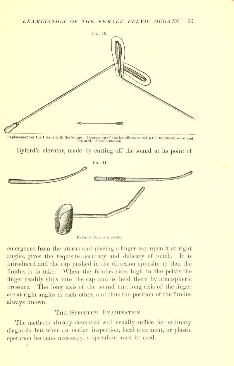 Fig. 10. Replacement of the Uterus with the Sound. Depression of the handle so as to tip the fundus upward and forward. Second motion. By ford's elevator, made by cutting off the sound at its point of Fig. 11. Byford's Uterine Elevator. emergence from the uterus and placing a finger-cap upon it at right angles, gives the requisite accuracy and delicacy of touch. It is introduced and the cap pushed in the direction opposite to that the fundus is to take. When the fundus rises high in the pelvis the ringer readily slips into the cap and is held there by atmospheric pressure. The long axis of the sound and long axis of the finger are at right angles to each other, and thus the position of the fundus always known. The Speculum Examination. The methods already described will usually suffice for ordinary diagnosis, but when an ocular inspection, local treatment, or plastic operation becomes necessary, a speculum must be used.