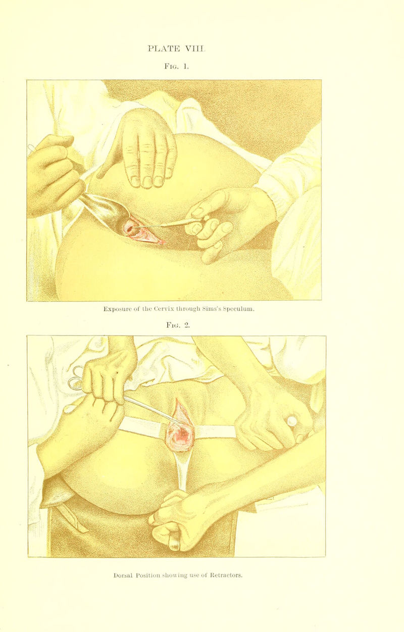 PLATE VIII Fig. 1. Exposure of the Cervix through Sims's Speculum. Fig. 2. Dorsal Position showing use of Retractors.