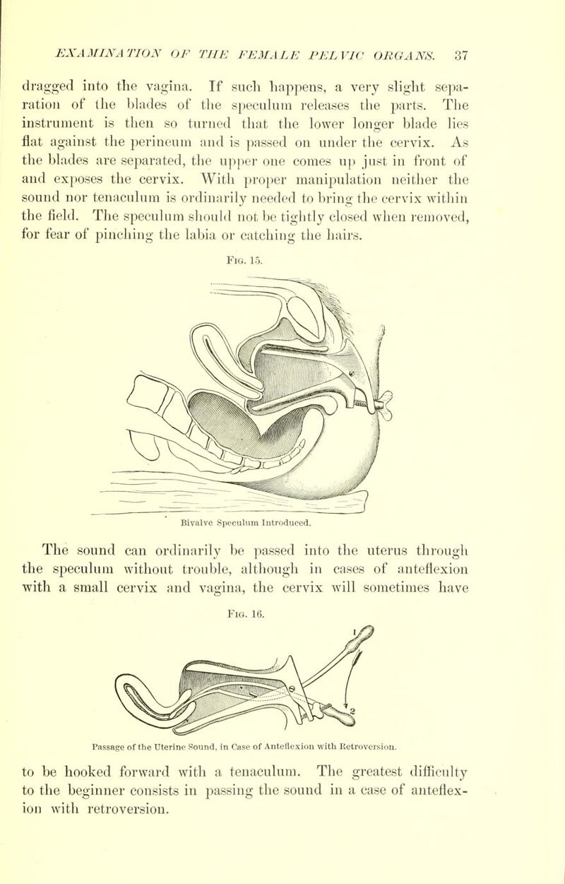 dragged into the vagina. If such happens, a very slight sepa- ration of the blades of the speculum releases the parts. The instrument is then so turned that the lower longer blade lies flat against the perineum and is passed on under the cervix. As the blades are separated, the upper one comes up just in front of and exposes the cervix. With proper manipulation neither the sound nor tenaculum is ordinarily needed to bring the cervix within the field. The speculum should not be tightly closed when removed, for fear of pinching the labia or catching the hairs. Fig. 15. Bivalve Speculum Introduced. The sound can ordinarily be passed into the uterus through the speculum without trouble, although in cases of anteflexion with a small cervix and vagina, the cervix will sometimes have Fig. 16. Passage of the Uterine Sound, in Case of Anteflexion with Retroversion. to be hooked forward with a tenaculum. The greatest difficulty to the beginner consists in passing the sound in a case of anteflex- ion with retroversion.