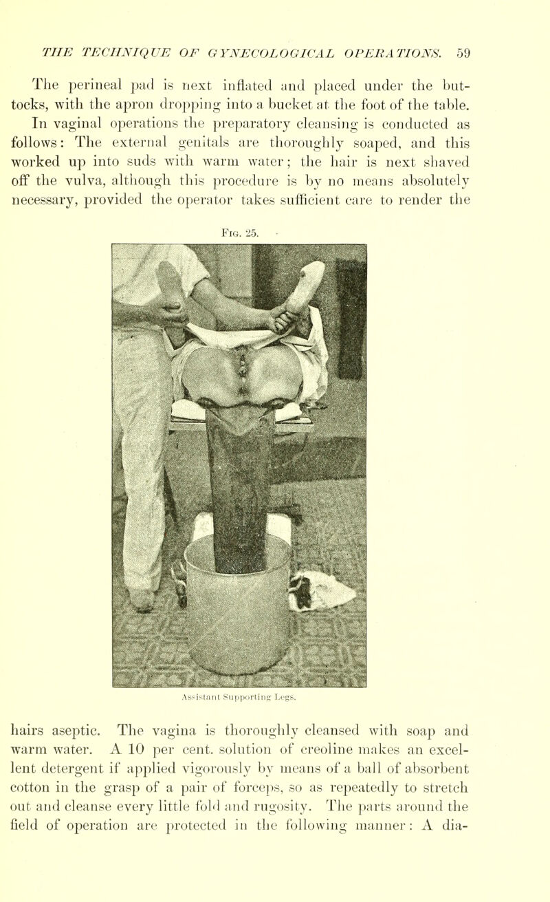The perineal pad is next inflated and placed under the but- tocks, with the apron dropping into a bucket at the foot of the table. In vaginal operations the preparatory cleansing is conducted as follows: The external genitals are thoroughly soaped, and this worked up into suds with warm water; the hair is next shaved off the vulva, although this procedure is by no means absolutely necessary, provided the operator takes sufficient care to render the Fm. 25. Assistant Supporting Legs. hairs aseptic. The vagina is thoroughly cleansed with soap and warm water. A 10 per cent, solution of creoline makes an excel- lent detergent if applied vigorously by means of a ball of absorbent cotton in the grasp of a pair of forceps, so as repeatedly to stretch out and cleanse every little fold and rugosity. The parts around the field of operation are protected in the following manner: A dia-