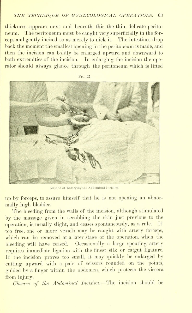 thickness, appears next, and beneath this the thin, delicate perito- neum. The peritoneum must be caught very superficially in the for- ceps and gently incised, so as merely to nick it. The intestines drop back the moment the smallest opening in the peritoneum is made, and then the incision can boldly be enlarged upward and downward to both extremities of the incision. In enlarging the incision the ope- rator should always glance through the peritoneum which is lifted Fig. 27. Method i't' Enlarging the Abdominal Incision. up by forceps, to assure himself that he is not opening an abnor- mally high bladder. The bleeding from the walls of the incision, although stimulated by the massage given in scrubbing the skin just previous to the operation, is usually slight, and ceases spontaneously, as a rule. If too free, one or more vessels may be caught with artery forceps, which can be removed at a later stage of the operation, when the bleeding will have ceased. Occasionally a large spouting artery requires immediate ligation with the finest silk or catgut ligature. If the incision proves too small, it may quickly be enlarged by cutting upward with a pair of scissors rounded on the points, guided by a finger within the abdomen, which protects the viscera from injury. Closure of the Abdominal Incision.—The incision should be