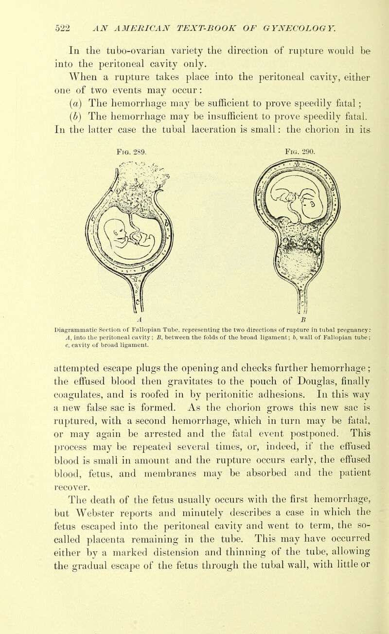In the tubo-ovarian variety the direction of rupture would be into the peritoneal cavity only. When a rupture takes place into the peritoneal cavity, either one of two events may occur: (a) The hemorrhage may be sufficient to prove speedily fatal; (b) The hemorrhage may be insufficient to prove speedily fatal. In the latter case the tubal laceration is small: the chorion in it& Fig. 289. Fig. 290. Diagrammatic Section of Fallopian Tube, representing the two directions of rupture in tubal pregnancy .- A, into the peritoneal cavity; B, between the folds of the broad ligament; 6, wall of Fallopian tube ; c, cavity of broad ligament. attempted escape plugs the opening and checks further hemorrhage ; the effused blood then gravitates to the pouch of Douglas, finally coagulates, and is roofed in by peritonitic adhesions. In this way a new false sac is formed. As the chorion grows this new sac is ruptured, with a second hemorrhage, which in turn may be fatal, or may again be arrested and the fatal event postponed. This process may be repeated several times, or, indeed, if the effused blood is small in amount and the rupture occurs early, the effused blood, fetus, and membranes may be absorbed and the patient recover. The death of the fetus usually occurs with the first hemorrhage, but Webster reports and minutely describes a case in which the fetus escaped into the peritoneal cavity and went to term, the so- called placenta remaining in the tube. This may have occurred either by a marked distension and thinning of the tube, allowing the gradual escape of the fetus through the tubal wall, with little or