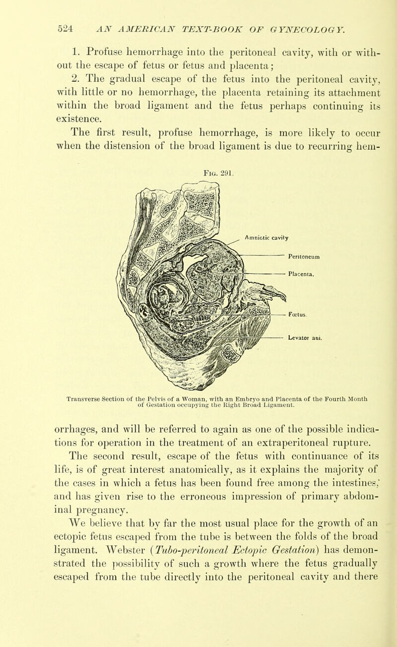 1. Profuse hemorrhage into the peritoneal cavity, with or with- out the escape of fetus or fetus and placenta; 2. The gradual escape of the fetus into the peritoneal cavity, with little or no hemorrhage, the placenta retaining its attachment within the broad ligament and the fetus perhaps continuing its existence. The first result, profuse hemorrhage, is more likely to occur when the distension of the broad ligament is due to recurring hem- Fig. 291. Transverse Section of the Pelvis of a Woman, with an Embryo and Placenta of the Fourth Month of Gestation occupying the Right Broad Ligament. orrhages, and will be referred to again as one of the possible indica- tions for operation in the treatment of an extraperitoneal rupture. The second result, escape of the fetus with continuance of its life, is of great interest anatomically, as it explains the majority of the cases in which a fetus has been found free among the intestines,' and has given rise to the erroneous impression of primary abdom- inal pregnancy. We believe that by far the most usual place for the growth of an ectopic fetus escaped from the tube is between the folds of the broad ligament. Webster (Tubo-peritoneal Ectopic Gestation) has demon- strated the possibility of such a growth where the fetus gradually escaped from the tube directly into the peritoneal cavity and there