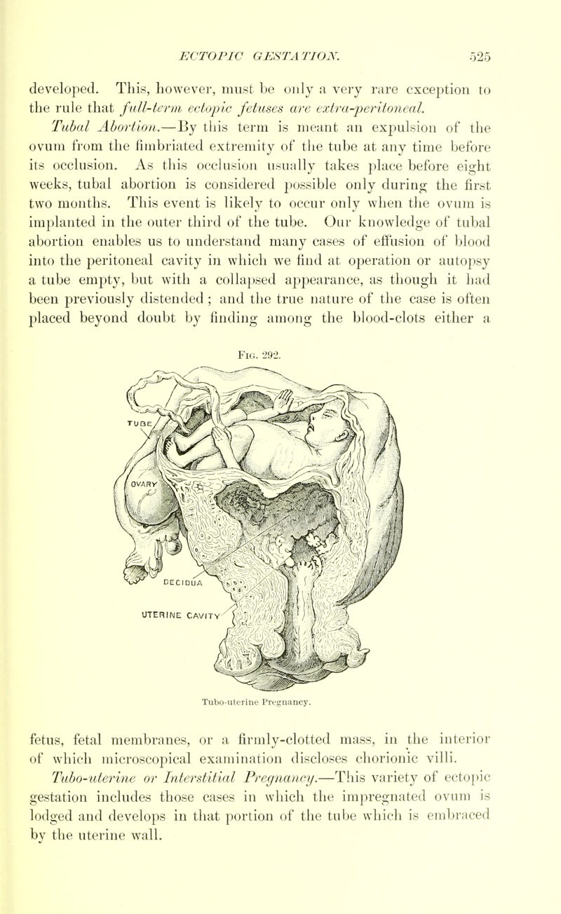 developed. This, however, must be only a very rare exception to the rule that fall-term ectopic fetuses are extra-peritoneal. Tubal Abortion..—By this term is meant an expulsion of the ovum from the fimbriated extremity of the tube at any time before its occlusion. As this occlusion usually takes place before eight weeks, tubal abortion is considered possible only during the first two months. This event is likely to occur only when the ovum is implanted in the outer third of the tube. Our knowledge of tubal abortion enables us to understand many cases of effusion of blood into the peritoneal cavity in which we find at operation or autopsy a tube empty, but with a collapsed appearance, as though it had been previously distended ; and the true nature of the case is often placed beyond doubt by finding among the blood-clots either a Fig. 292. Tubo-uterine Pregnancy. fetus, fetal membranes, or a firmly-clotted mass, in the interior of which microscopical examination discloses chorionic villi. Tubo-uterine or Interstitial Pregnancy.—This variety of ectopic gestation includes those cases in which the impregnated ovum is lodged and develops in that portion of the tube which is embraced by the uterine wall.