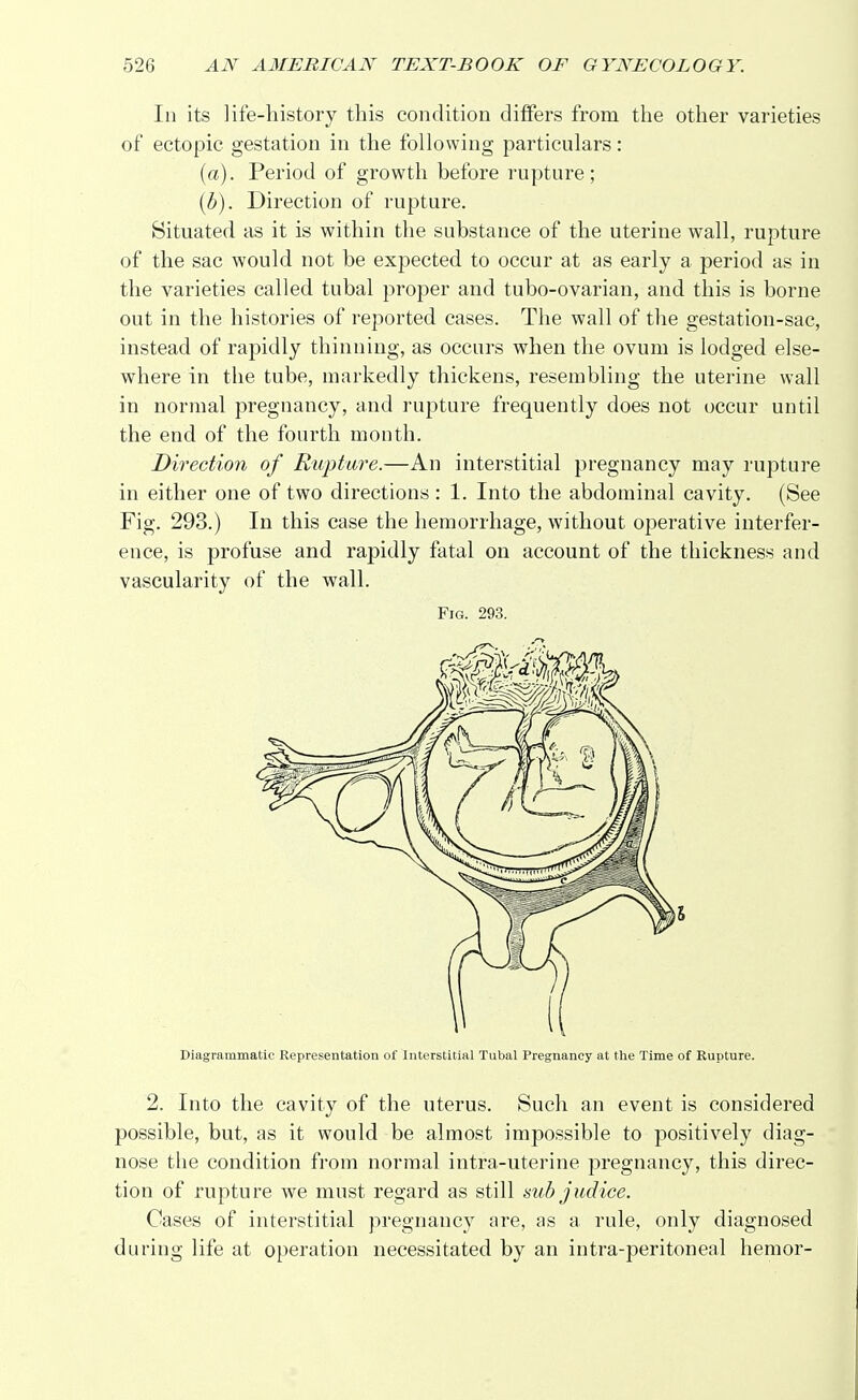 In its life-history this condition differs from the other varieties of ectopic gestation in the following particulars: (a) . Period of growth before rupture; (b) . Direction of rupture. Situated as it is within the substance of the uterine wall, rupture of the sac would not be expected to occur at as early a period as in the varieties called tubal proper and tubo-ovarian, and this is borne out in the histories of reported cases. The wall of the gestation-sac, instead of rapidly thinning, as occurs when the ovum is lodged else- where in the tube, markedly thickens, resembling the uterine wall in normal pregnancy, and rupture frequently does not occur until the end of the fourth month. Direction of Rupture.—An interstitial pregnancy may rupture in either one of two directions : 1. Into the abdominal cavity. (See Fig. 293.) In this case the hemorrhage, without operative interfer- ence, is profuse and rapidly fatal on account of the thickness and vascularity of the wall. Fig. 293. Diagrammatic Representation of Interstitial Tubal Pregnancy at the Time of Rupture. 2. Into the cavity of the uterus. Such an event is considered possible, but, as it would be almost impossible to positively diag- nose the condition from normal intra-uterine pregnancy, this direc- tion of rupture we must regard as still sub judice. Cases of interstitial pregnancy are, as a rule, only diagnosed during life at operation necessitated by an intra-peritoneal hemor-