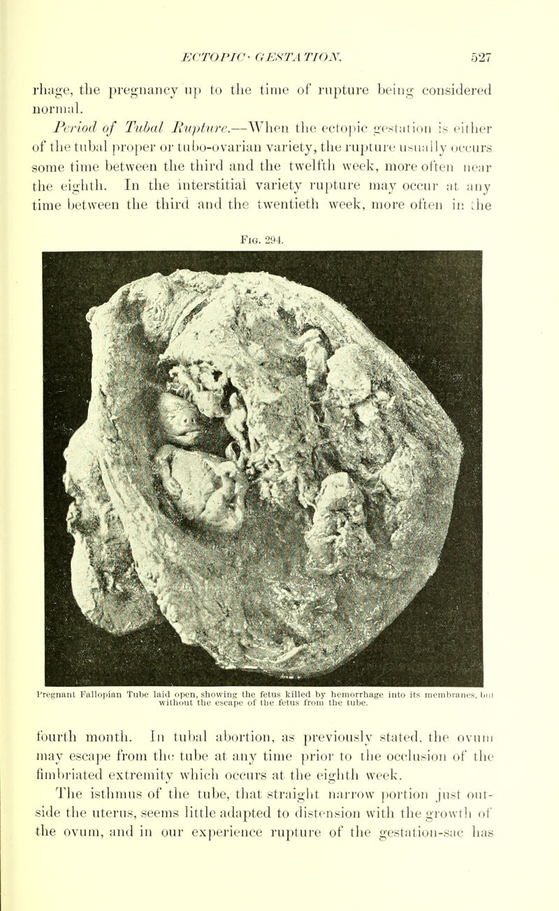 rhage, the pregnancy up to the time of rupture being considered normal. Period of Tubal Rupture.—When the ectopic gestation is either of the tubal proper or tubo-ovarian variety, the rupture usually occurs some time between the third and the twelfth week, more often near the eighth. In the interstitial variety rupture may occur at any time between the third and the twentieth week, more often in the Fig. 294. Pregnant Fallopian Tube laid open, showing the fetus killed by hemorrhage into its membranes, bin without the escape of the fetus from the tube. fourth month. In tubal abortion, as previously stated, the ovum may escape from the tube at any time prior to the occlusion of the fimbriated extremity which occurs at the eighth week. The isthmus of the tube, that straight narrow portion just out- side the uterus, seems little adapted to distension with the growth of the ovum, and in our experience ruj)ture of the gestation-sae has