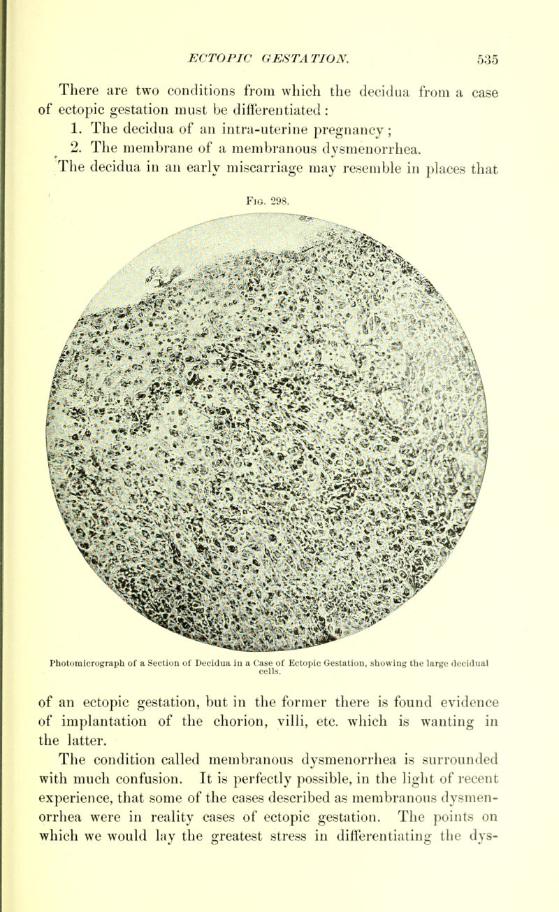 There are two conditions from which the decidua from a case of ectopic gestation must be differentiated : 1. The decidua of an intra-uterine pregnancy; 2. The membrane of a membranous dysmenorrhea. The decidua in an early miscarriage may resemble in places that Fig. 298. Photomicrograph of a Section of Decidua in a Case of Ectopic Gestation, showing the large decidual of an ectopic gestation, but in the former there is found evidence of implantation of the chorion, villi, etc. which is wanting in the latter. The condition called membranous dysmenorrhea is surrounded with much confusion. It is perfectly possible, in the light of recent experience, that some of the cases described as membranous dysmen- orrhea were in reality cases of ectopic gestation. The points on which we would lay the greatest stress in differentiating the dys-