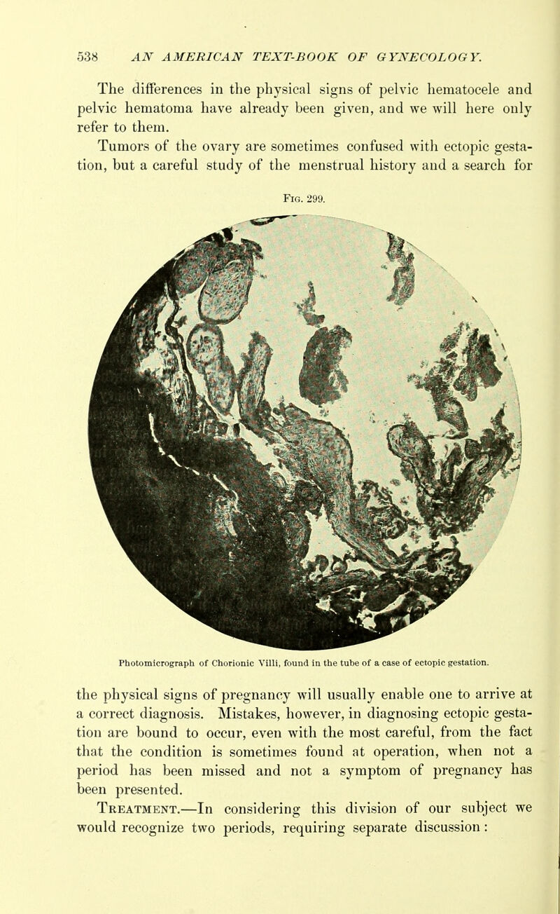 The differences in the physical signs of pelvic hematocele and pelvic hematoma have already been given, and we will here only refer to them. Tumors of the ovary are sometimes confused with ectopic gesta- tion, but a careful study of the menstrual history and a search for Fig. 299. Photomicrograph of Chorionic Villi, found in the tube of a case of ectopic gestation. the physical signs of pregnancy will usually enable one to arrive at a correct diagnosis. Mistakes, however, in diagnosing ectopic gesta- tion are bound to occur, even with the most careful, from the fact that the condition is sometimes found at operation, when not a period has been missed and not a symptom of pregnancy has been presented. Treatment.—In considering this division of our subject we would recognize two periods, requiring separate discussion :