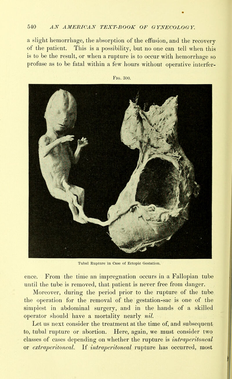 a slight hemorrhage, the absorption of the effusion, and the recovery of the patient. This is a possibility, but no one can tell when this is to be the result, or when a rupture is to occur with hemorrhage so profuse as to be fatal within a few hours without operative interfer- Fig. 300. Tubal Rupture in Case of Ectopic Gestation. ence. From the time an impregnation occurs in a Fallopian tube until the tube is removed, that patient is never free from danger. Moreover, during the period prior to the rupture of the tube the operation for the removal of the gestation-sac is one of the simplest in abdominal surgery, and in the hands of a skilled operator should have a mortality nearly nil. Let us next consider the treatment at the time of, and subsequent to, tubal rupture or abortion. Here, again, we must consider two classes of cases depending on whether the rupture is intraperitoneal or extraperitoneal. If intraperitoneal rupture has occurred, most