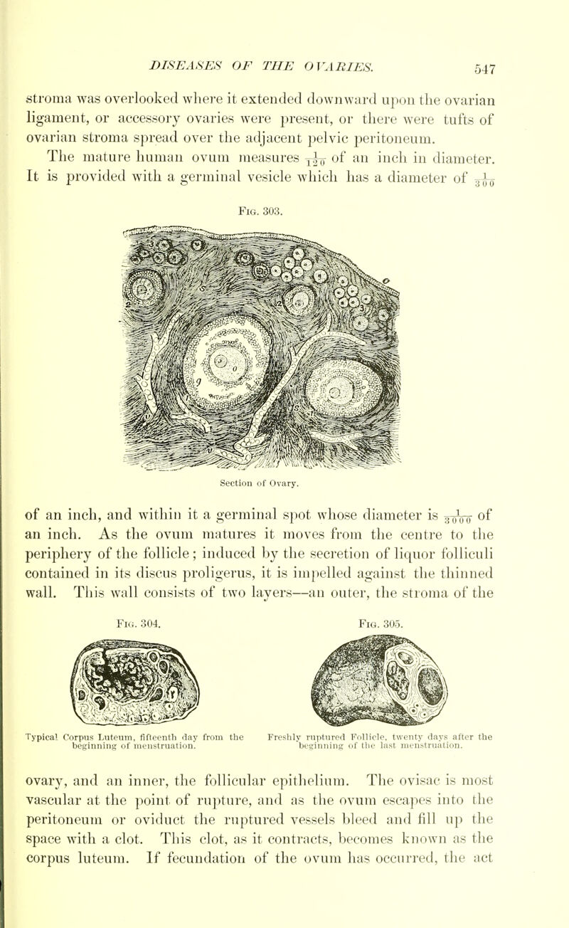 stroma was overlooked where it extended downward upon the ovarian ligament, or accessory ovaries were present, or there were tufts of ovarian stroma spread over the adjacent pelvic peritoneum. The mature human ovum measures of an inch in diameter. It is provided with a germinal vesicle which has a diameter of ^ Fig. 303. Section of Ovary. of an inch, and within it a germinal spot whose diameter is of an inch. As the ovum matures it moves from the centre to the periphery of the follicle ; induced by the secretion of liquor folliculi contained in its discus proligerus, it is impelled against the thinned wall. This wall consists of two layers—an outer, the stroma of the Fig. 304. Fig. 305. Typical Corpus Luteum, fifteenth day from the Freshly ruptured Follicle, twenty days after the beginning of menstruation. beginning of the last menstruation. ovary, and an inner, the follicular epithelium. The ovisac is most vascular at the point of rupture, and as the ovum escapes into the peritoneum or oviduct the ruptured vessels bleed and fill up the space with a clot. This clot, as it contracts, becomes known as the corpus luteum. If fecundation of the ovum has occurred, the act