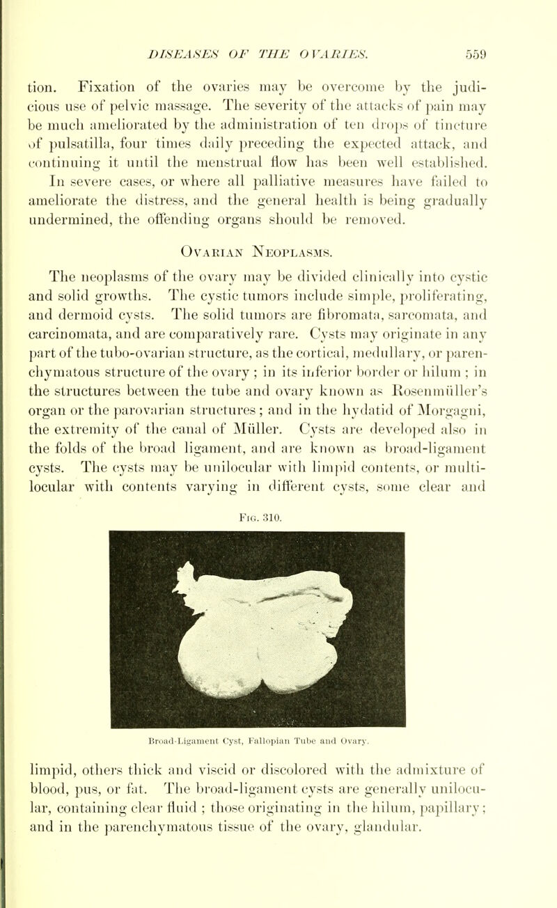 tion. Fixation of the ovaries may be overcome by the judi- cious use of pelvic massage. The severity of the attacks of pain may be much ameliorated by the administration of ten drops of tincture of pulsatilla, four times daily preceding the expected attack, and continuing it until the menstrual flow has been well established. In severe cases, or where all palliative measures have failed to ameliorate the distress, and the general health is being gradually undermined, the offending organs should be removed. Ovarian Neoplasms. The neoplasms of the ovary may be divided clinically into cystic and solid growths. The cystic tumors include simple, proliferating, and dermoid cysts. The solid tumors are fibromata, sarcomata, and carcinomata, and are comparatively rare. Cysts may originate in any part of the tubo-ovarian structure, as the cortical, medullary, or paren- chymatous structure of the ovary ; in its inferior border or hilum ; in the structures between the tube and ovary known as Rosenmiiller's organ or the parovarian structures ; and in the hydatid of Morgagni, the extremity of the canal of Midler. Cysts are developed also in the folds of the broad ligament, and are known as broad-ligament cysts. The cysts may be unilocular with limpid contents, or multi- locular with contents varying in different cysts, some clear and Fig. 310. Broad-Ligament Cyst, Fallopian Tube and Ovary. limpid, others thick and viscid or discolored with the admixture of blood, pus, or fat. The broad-ligament cysts are generally unilocu- lar, containing clear fluid ; those originating in the hilum, papillary; and in the parenchymatous tissue of the ovary, glandular.
