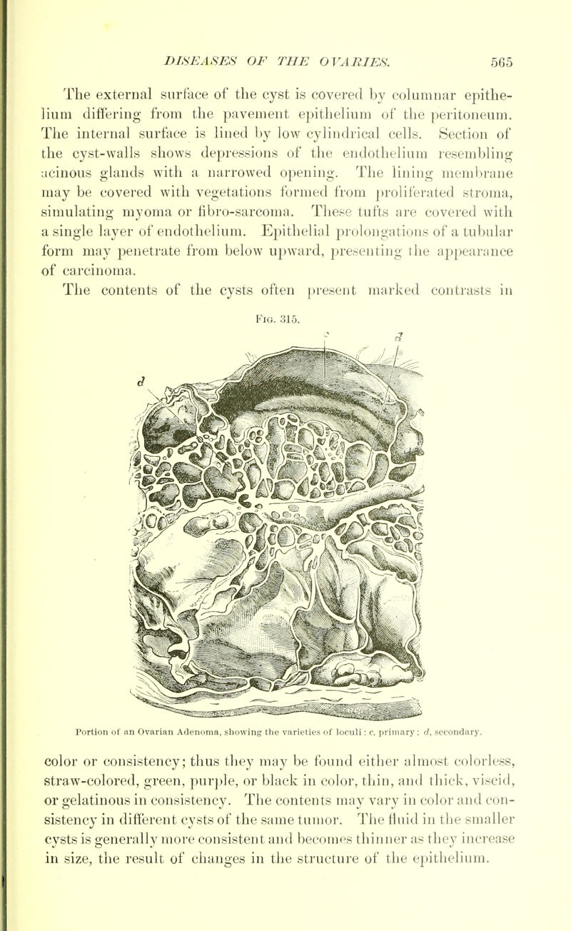 The external surface of the cyst is covered by columnar epithe- lium differing from the pavement epithelium of the peritoneum. The internal surface is lined by low cylindrical cells. Section of the cyst-walls shows depressions of the endothelium resembling acinous glands with a narrowed opening. The lining membrane may be covered with vegetations formed from proliferated stroma, simulating myoma or fibro-sarcoma. These tufts are covered with a single layer of endothelium. Epithelial prolongations of a tubular form may penetrate from below upward, presenting the appearance of carcinoma. The contents of the cysts often present marked contrasts in Fig. 315. Portion of an Ovarian Adenoma, showing the varieties of loculi: c, primary; d, secondary. color or consistency; thus they may be found either almost colorless, straw-colored, green, purple, or black in color, thin, and thick, viscid, or gelatinous in consistency. The contents may vary in color and con- sistency in different cysts of the same tumor. The fluid in the smaller cysts is generally more consistent and becomes thinner as they increase in size, the result of changes in the structure of the epithelium.