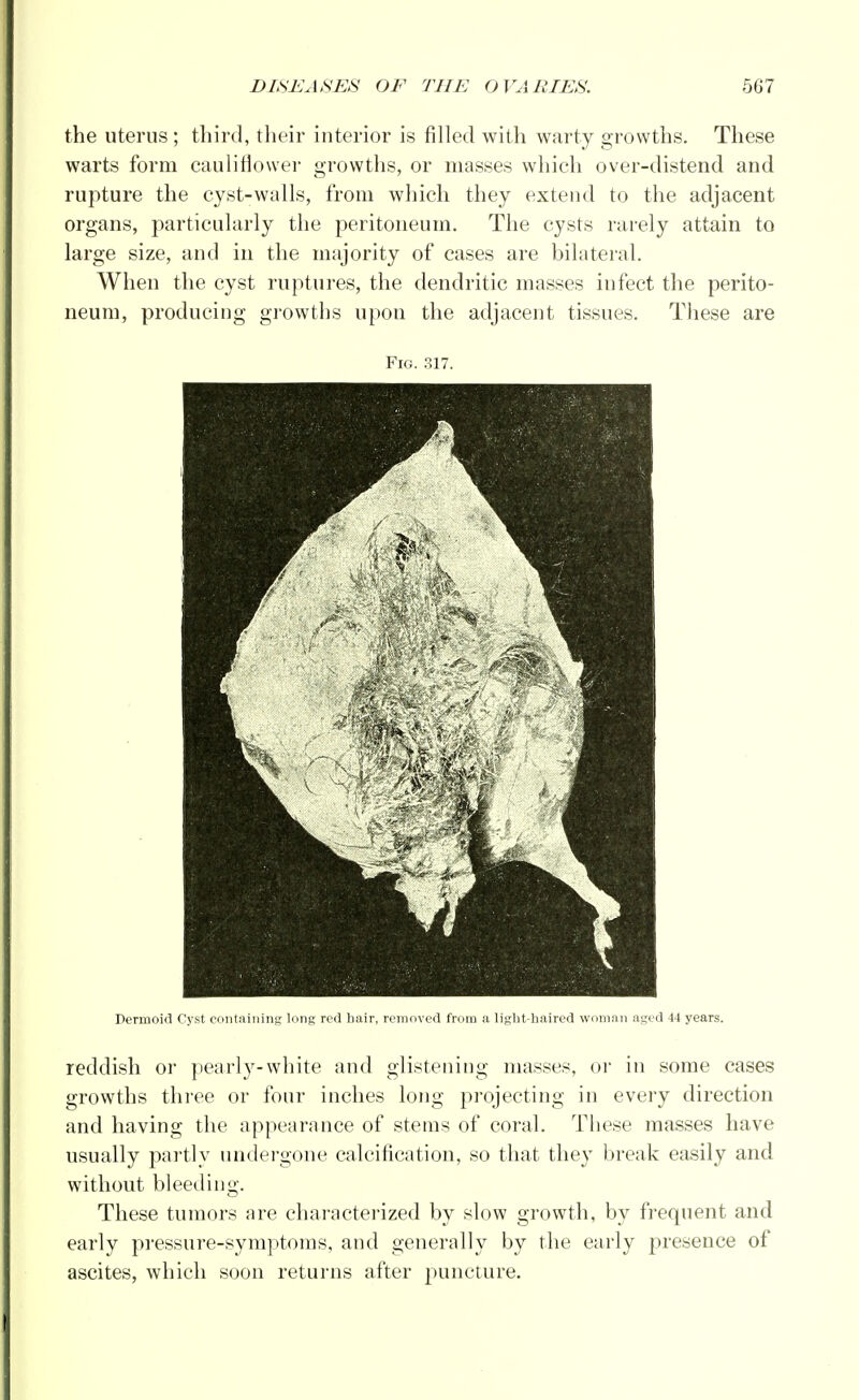 the uterus; third, their interior is rilled with warty growths. These warts form cauliflower growths, or masses which over-distend and rupture the cyst-walls, from which they extend to the adjacent organs, particularly the peritoneum. The cysts rarely attain to large size, and in the majority of cases are bilateral. When the cyst ruptures, the dendritic masses infect the perito- neum, producing growths upon the adjacent tissues. These are Fig. 317. Dermoid Cyst containing long red hair, removed from a light-haired woman aged 44 years. reddish or pearly-white and glistening masses, or in some cases growths three or four inches long projecting in every direction and having the appearance of stems of coral. These masses have usually partly undergone calcification, so that they break easily and without bleeding. These tumors are characterized by slow growth, by frequent and early pressure-symptoms, and generally by the early presence of ascites, which soon returns after puncture.