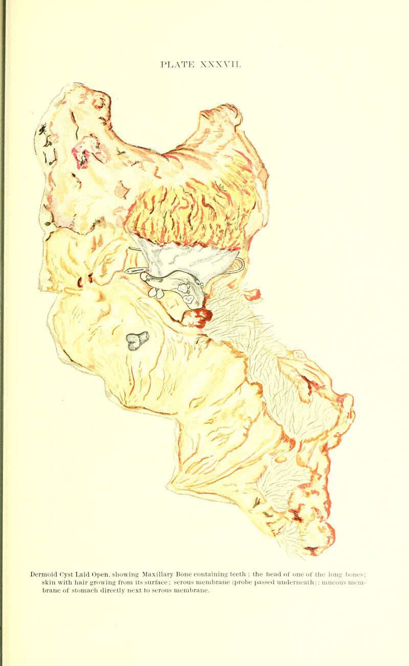 PLATE XXXVII. Dermoid Cyst Laid Open, showing Maxillary Bone containing teeth ; the head of one of the long bones skin with hair growing from its surface; serous membrane (probe passed underneath); mucous mem brane of stomach directly next to serous membrane.