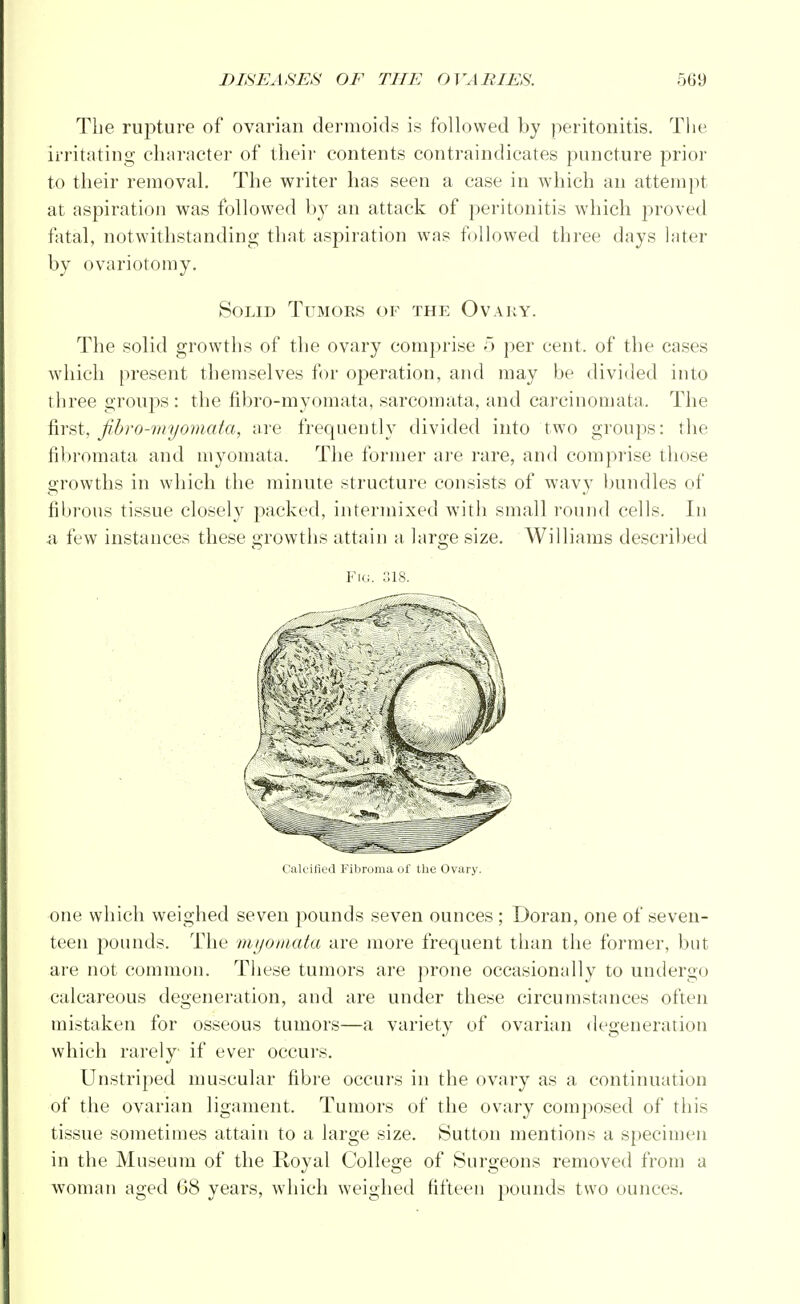 The rupture of ovarian dermoids is followed by peritonitis. The irritating character of their contents contraindicates puncture prior to their removal. The writer has seen a case in which an attempt at aspiration was followed by an attack of peritonitis which proved fatal, notwithstanding that aspiration was followed three days later by ovariotomy. Solid Tumors of the Ovary. The solid growths of the ovary comprise 5 per cent, of the cases which present themselves for operation, and may be divided into three groups : the fibro-myomata, sarcomata, and carcinomata. The first, fibro-myomata, are frequently divided into two groups: the fibromata and myomata. The former are rare, and comprise those growths in which the minute structure consists of wavy bundles of fibrous tissue closely packed, intermixed with small round cells. In a few instances these growths attain a large size. Williams described Fig. 318. Calcified Fibroma of the Ovary. one which weighed seven pounds seven ounces ; Doran, one of seven- teen pounds. The myomata are more frequent than the former, but are not common. These tumors are prone occasionally to undergo calcareous degeneration, and are under these circumstances often mistaken for osseous tumors—a variety of ovarian degeneration which rarely if ever occurs. Unstriped muscular fibre occurs in the ovary as a continuation of the ovarian ligament. Tumors of the ovary composed of this tissue sometimes attain to a large size. Sutton mentions a specimen in the Museum of the Royal College of Surgeons removed from a woman aged G8 years, which weighed fifteen pounds two ounces.