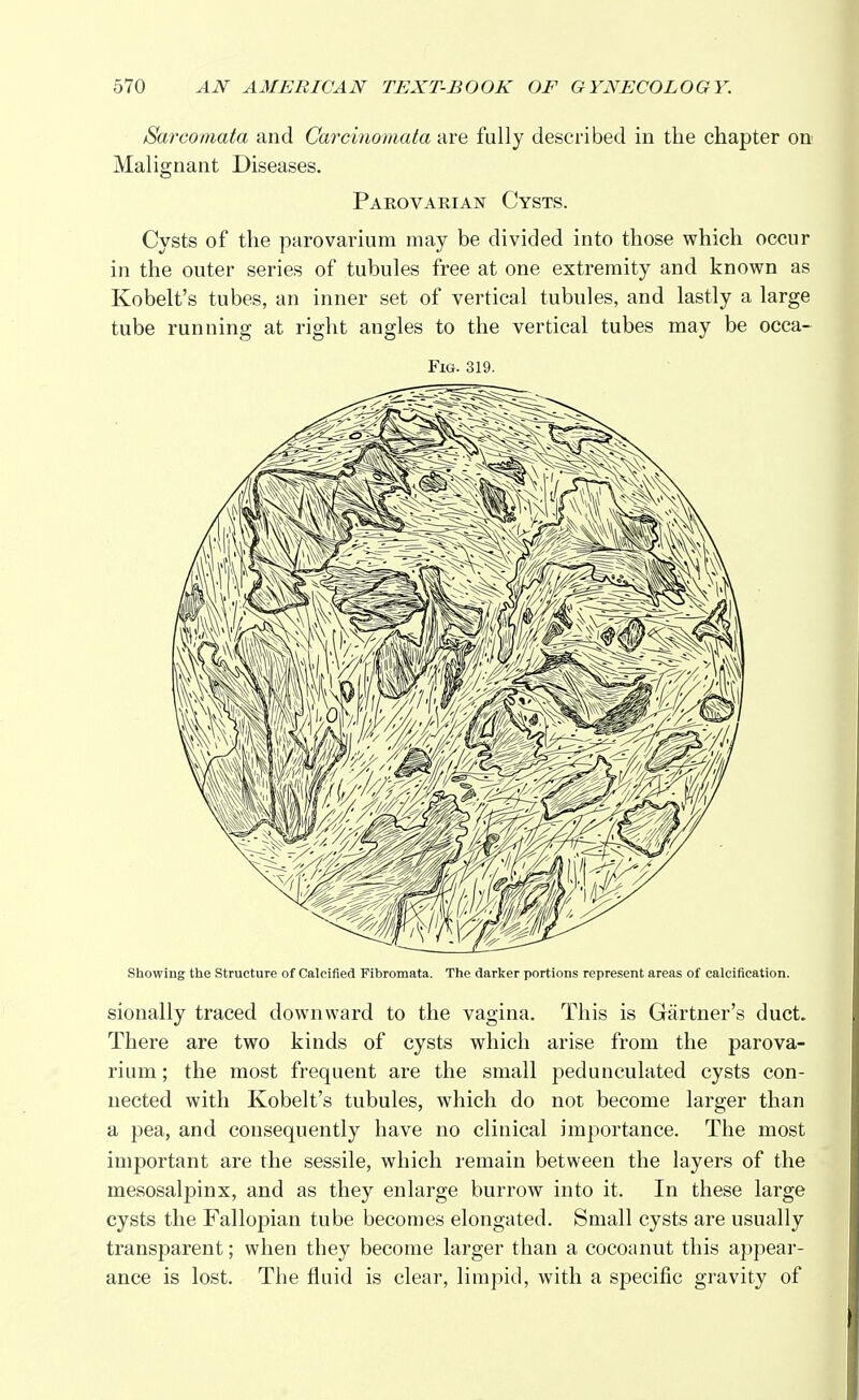 Sarcomata and Carcinomata are fully described in the chapter on Malignant Diseases. Parovaeian Cysts. Cysts of the parovarium may be divided into those which occur in the outer series of tubules free at one extremity and known as Kobelt's tubes, an inner set of vertical tubules, and lastly a large tube running at right angles to the vertical tubes may be occa- Fig. 319. Showing the Structure of Calcified Fibromata. The darker portions represent areas of calcification. sionally traced downward to the vagina. This is Gartner's duct. There are two kinds of cysts which arise from the parova- rium ; the most frequent are the small pedunculated cysts con- nected with Kobelt's tubules, which do not become larger than a pea, and consequently have no clinical importance. The most important are the sessile, which remain between the layers of the mesosalpinx, and as they enlarge burrow into it. In these large cysts the Fallopian tube becomes elongated. Small cysts are usually transparent; when they become larger than a cocoanut this appear- ance is lost. The fluid is clear, limpid, with a specific gravity of