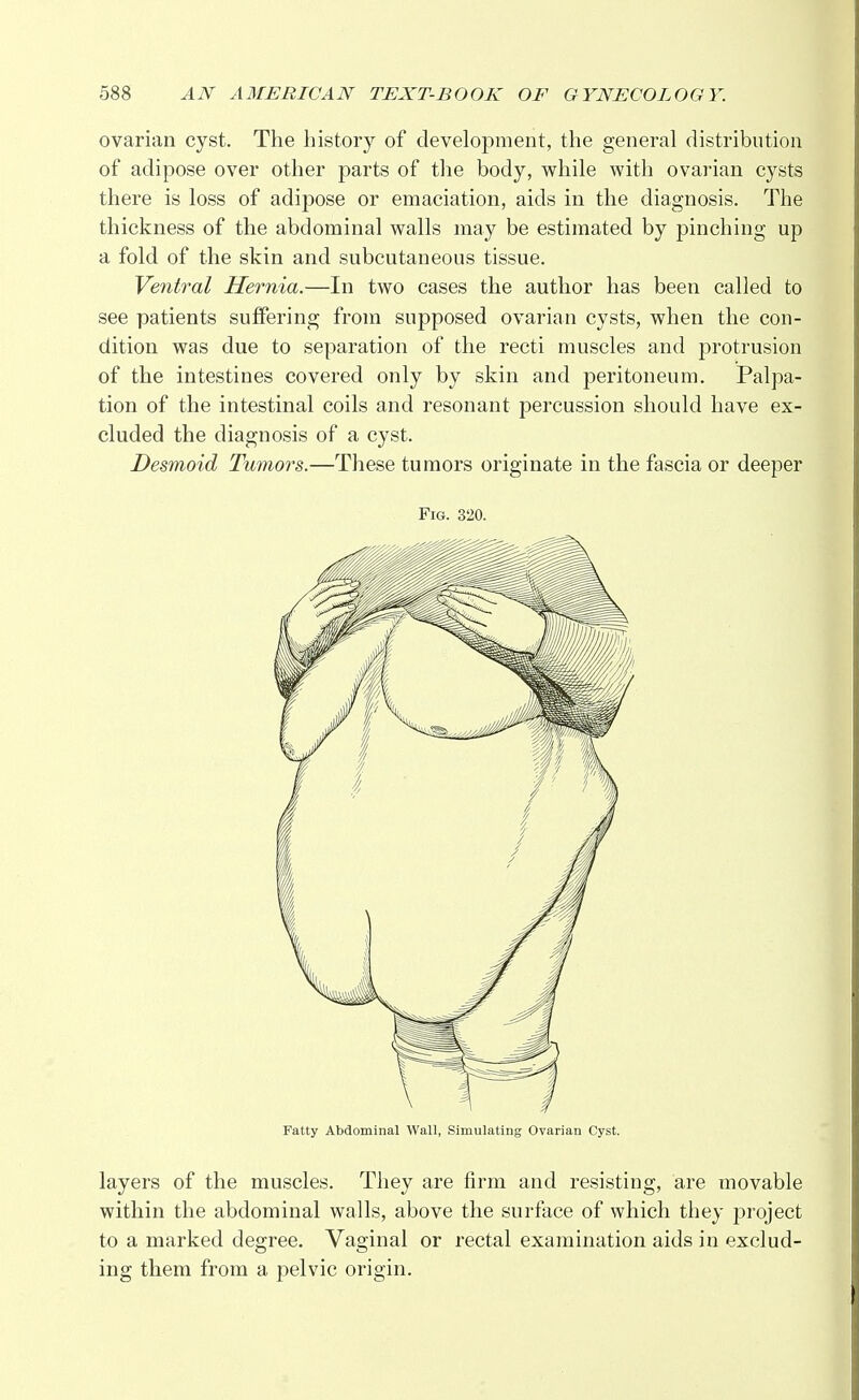 ovarian cyst. The history of development, the general distribution of adipose over other parts of the body, while with ovarian cysts there is loss of adipose or emaciation, aids in the diagnosis. The thickness of the abdominal walls may be estimated by pinching up a fold of the skin and subcutaneous tissue. Ventral Hernia.—In two cases the author has been called to see patients suffering from supposed ovarian cysts, when the con- dition was due to separation of the recti muscles and protrusion of the intestines covered only by skin and peritoneum. Palpa- tion of the intestinal coils and resonant percussion should have ex- cluded the diagnosis of a cyst. Desmoid Tumors.—These tumors originate in the fascia or deeper Fig. 320. Fatty Abdominal Wall, Simulating Ovarian Cyst. layers of the muscles. They are firm and resisting, are movable within the abdominal walls, above the surface of which they project to a marked degree. Vaginal or rectal examination aids in exclud- ing them from a pelvic origin.