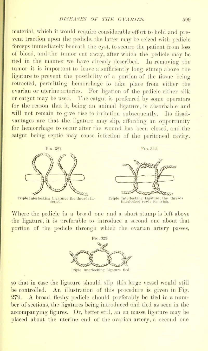 material, which it would require considerable effort to hold and pre- vent traction upon the pedicle, the latter may be seized with pedicle forceps immediately beneath the cyst, to secure the patient from loss of blood, and the tumor cut away, after which the pedicle may be tied in the manner we have already described. In removing the tumor it is important to leave a sufficiently long stump above the ligature to prevent the possibility of a portion of the tissue being retracted, permitting hemorrhage to take place from either the ovarian or uterine arteries. For ligation of the pedicle either silk or catgut may be used. The catgut is preferred by some operators for the reason that it, being an animal ligature, is absorbable and will not remain to give rise to irritation subsequently. Its disad- vantages are that the ligature may slip, affording an opportunity for hemorrhage to occur after the wound has been closed, and the catgut being septic may cause infection of the peritoneal cavity. Fig. 321. Triple Interlocking Ligature ; the threads in- serted. Fig. 322. r/&zn § ) Triple Interlocking Ligature; the threads interlocked ready for tying. Where the pedicle is a broad one and a short stump is left above the ligature, it is preferable to introduce a second one about that portion of the pedicle through which the ovarian artery passes, Fig. 323. Triple Interlocking Ligature tied. so that in case the ligature should slip this large vessel would still be controlled. An illustration of this procedure is given in Fig. 279. A broad, fleshy pedicle should preferably be tied in a num- ber of sections, the ligatures being introduced and tied as seen in the accompanying figures. Or, better still, an en masse ligature may be placed about the uterine end of the ovarian artery, a second one