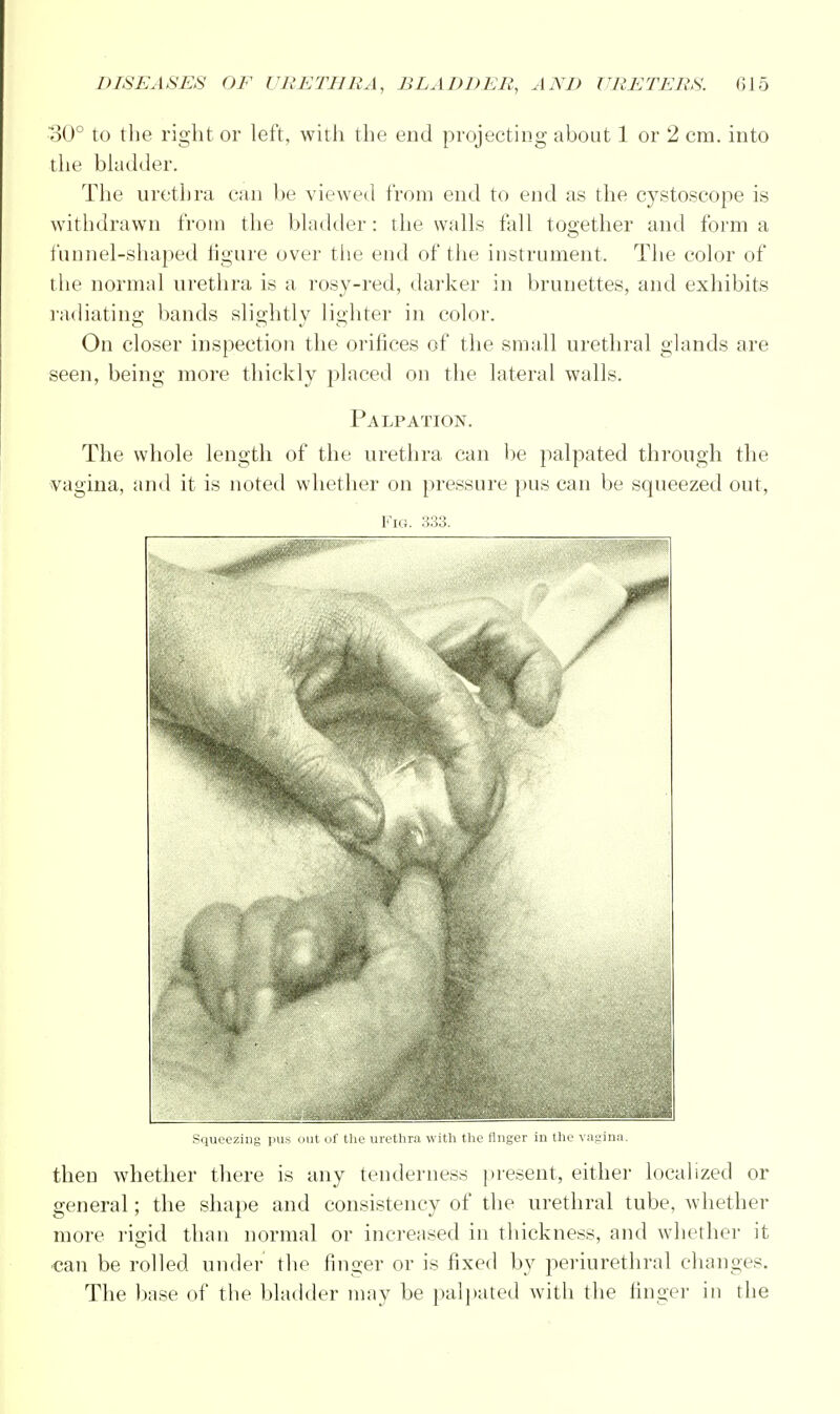 •SO0 to the right or left, with the end projecting about 1 or 2 cm. into the bladder. The urethra can be viewed from end to end as the cystoscope is withdrawn from the bladder: the walls fall together and form a funnel-shaped figure over the end of the instrument. The color of the normal urethra is a rosy-red, darker in brunettes, and exhibits radiating bands slightly lighter in color. On closer inspection the orifices of the small urethral glands are seen, being more thickly placed on the lateral walls. Palpation. The whole length of the urethra can be palpated through the vagina, and it is noted whether on pressure pus can be squeezed out, Fig. 333. Squeezing pus out of the urethra with the ringer in the vagina. then whether there is any tenderness present, either localized or general; the shape and consistency of the urethral tube, whether more rigid than normal or increased in thickness, and whether it can be rolled under the finger or is fixed by periurethral changes. The base of the bladder may he palpated with the finger in the