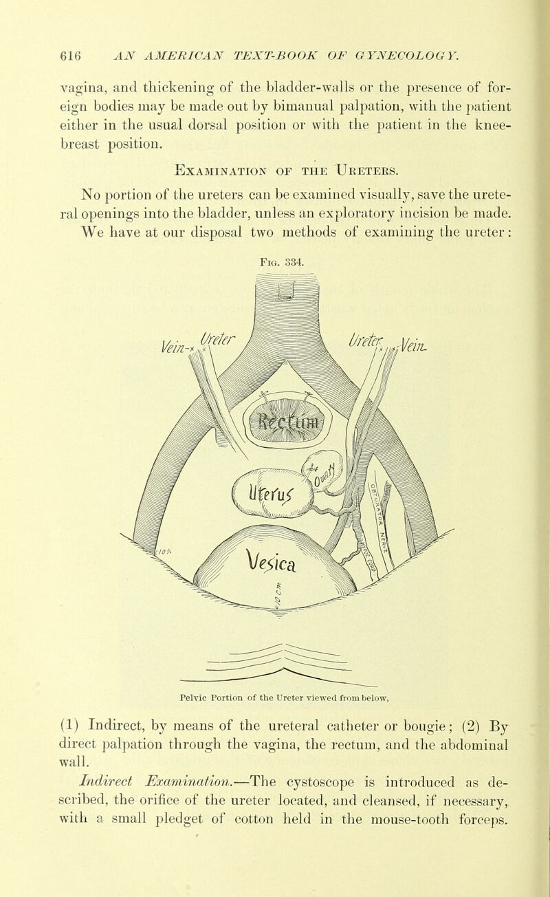 vagina, and thickening of the bladder-walls or the presence of for- eign bodies may be made out by bimanual palpation, with the patient either in the usual dorsal position or with the patient in the knee- breast position. Examination of the Ureters. No portion of the ureters can be examined visually, save the urete- ral openings into the bladder, unless an exploratory incision be made. We have at our disposal two methods of examining the ureter : Fig. 334. Pelvic Portion of the Ureter viewed from below, (1) Indirect, by means of the ureteral catheter or bougie; (2) By direct palpation through the vagina, the rectum, and the abdominal wall. Indirect Examination.—The cystoscope is introduced as de- scribed, the orifice of the ureter located, and cleansed, if necessary, with a small pledget of cotton held in the mouse-tooth forceps.