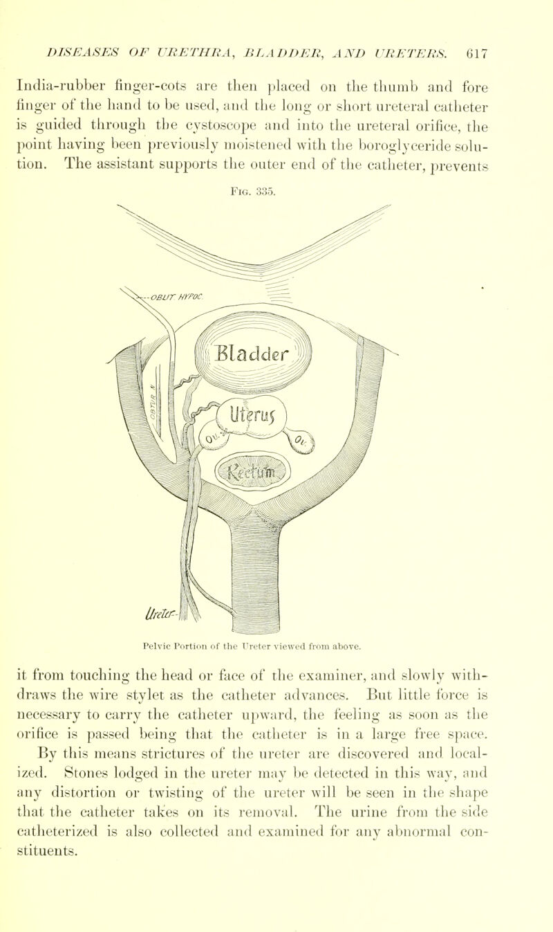 India-rubber finger-cots are then placed on the thumb and fore finger of the hand to be used, and the long or short ureteral catheter is guided through the cystoscope and into the ureteral orifice, the point having been previously moistened with the boroglyceride solu- tion. The assistant supports the outer end of the catheter, prevents Fig. 335. Pelvic Portion of the Ureter viewed from above. it from touching the head or face of the examiner, and slowly with- draws the wire stylet as the catheter advances. But little force is necessary to carry the catheter upward, the feeling as soon as the orifice is passed being that the catheter is in a large free space. By this means strictures of the ureter are discovered and. local- ized. Stones lodged in the ureter may be detected in this way, and any distortion or twisting of the ureter will be seen in the shape that the catheter takes on its removal. The urine from the side catheterized is also collected and examined for any abnormal con- stituents.