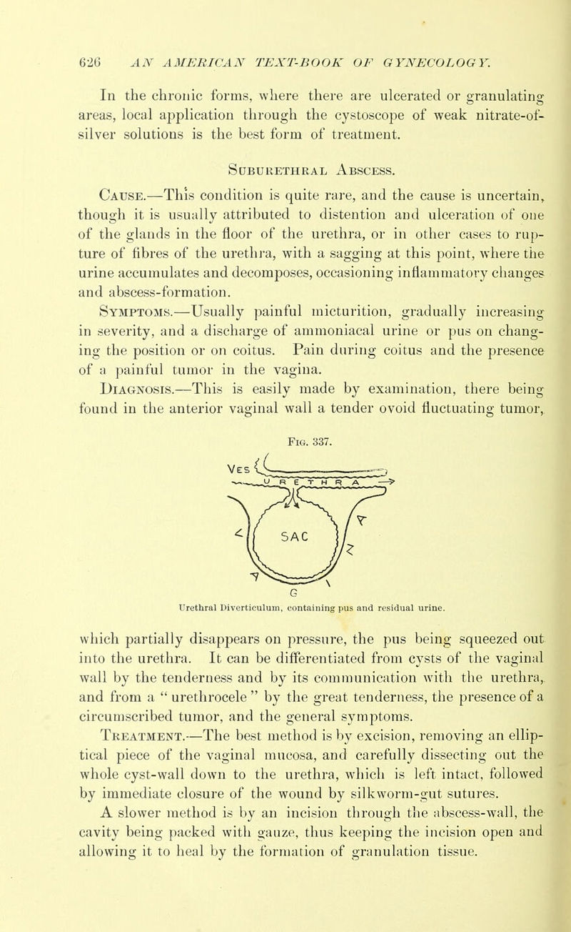 In the chronic forms, where there are ulcerated or granulating areas, local application through the cystoscope of weak nitrate-of- silver solutions is the best form of treatment. Suburethral Abscess. Cause.—This condition is quite rare, and the cause is uncertain, though it is usually attributed to distention and ulceration of one of the glands in the floor of the urethra, or in other cases to rup- ture of fibres of the urethra, with a sagging at this point, where the urine accumulates and decomposes, occasioning inflammatory changes and abscess-formation. Symptoms.—Usually painful micturition, gradually increasing in severity, and a discharge of ammoniacal urine or pus on chang- ing the position or on coitus. Pain during coitus and the presence of a painful tumor in the vagina. Diagnosis.—This is easily made by examination, there being found in the anterior vaginal wall a tender ovoid fluctuating tumor, Fig. 337. G Urethral Diverticulum, containing pus and residual urine. which partially disappears on pressure, the pus being squeezed out into the urethra. It can be differentiated from cysts of the vaginal wall by the tenderness and by its communication with the urethra, and from a  urethrocele  by the great tenderness, the presence of a circumscribed tumor, and the general symptoms. Treatment.—The best method is by excision, removing an ellip- tical piece of the vaginal mucosa, and carefully dissecting out the whole cyst-wall down to the urethra, which is left intact, followed by immediate closure of the wound by silkworm-gut sutures. A slower method is by an incision through the abscess-wall, the cavity being packed with gauze, thus keeping the incision open and allowing it to heal by the formation of granulation tissue.