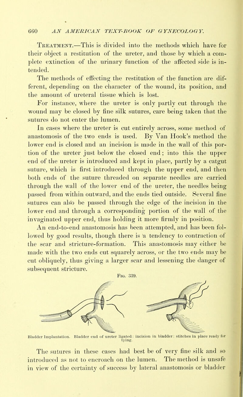 Treatment.—This is divided into the methods which have for their object a restitution of the ureter, and those by which a com- plete extinction of the urinary function of the affected side is in- tended. The methods of effecting the restitution of the function are dif- ferent, depending on the character of the wound, its position, and the amount of ureteral tissue which is lost. For instance, where the ureter is only partly cut through the wound may be closed by fine silk sutures, care being taken that the sutures do not enter the lumen. In cases where the ureter is cut entirely across, some method of anastomosis of the two ends is used. By Van Hook's method the lower end is closed and an incision is made in the wall of this por- tion of the ureter just below the closed end; into this the upper end of the ureter is introduced and kept in place, partly by a catgut suture, which is first introduced through the upper end, and then both ends of the suture threaded on separate needles are carried through the wall of the lower end of the ureter, the needles being passed from within outward, and the ends tied outside. Several fine sutures can alst> be passed through the edge of the incision in the lower end and through a corresponding portion of the wall of the invaginated upper end, thus holding it more firmly in position. An end-to-end anastomosis has been attempted, and has been fol- lowed by good results, though there is a tendency to contraction of the scar and stricture-formation. This anastomosis may either be made with the two ends cut squarely across, or the two ends may be cut obliquely, thus giving a larger scar and lessening the danger of subsequent stricture. Fig. 339. Bladder Implantation. Bladder end of ureter ligated : incision in bladder: stitches in place ready for tying. The sutures in these cases had best be of very fine silk and so introduced as not to encroach on the lumen. The method is unsafe in view of the certainty of success by lateral anastomosis or bladder