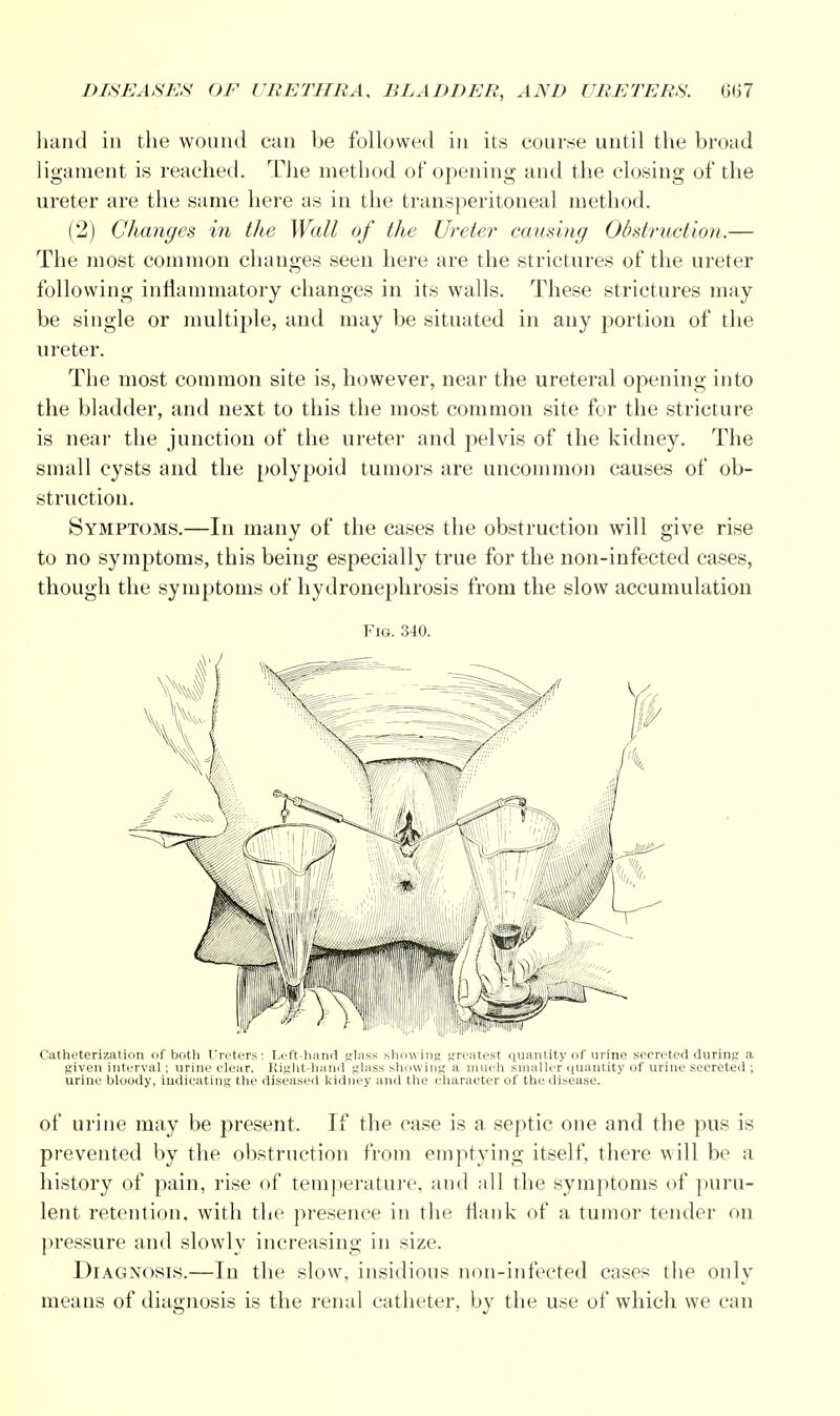 hand in the wound can be followed in its course until the broad ligament is reached. The method of opening and the closing of the ureter are the same here as in the transperitoneal method. (2) Changes in the Wall of the Ureter causing Obstruction.— The most common changes seen here are the strictures of the ureter following inflammatory changes in its walls. These strictures may be single or multiple, and may be situated in any portion of the ureter. The most common site is, however, near the ureteral opening into the bladder, and next to this the most common site for the stricture is near the junction of the ureter and pelvis of the kidney. The small cysts and the polypoid tumors are uncommon causes of ob- struction. Symptoms.—In many of the cases the obstruction will give rise to no symptoms, this being especially true for the non-infected cases, though the symptoms of hydronephrosis from the slow accumulation Fig. 340. Catheterization of both Ureters: Left-hand glass showing greatest quantity of urine secreted during a given interval; urine clear. Right-hand glass showing a much smaller quantity of urine secreted ; urine bloody, indicating the diseased kidney and the character of the disease. of urine may be present. If the case is a septic one and the pus is prevented by the obstruction from emptying itself, there will be a history of pain, rise of temperature, and all the symptoms of puru- lent retention, with the presence in the flank of a tumor tender on pressure and slowly increasing in size. Diagnosis.—In the slow, insidious non-infected cases the only means of diagnosis is the renal catheter, by the use of which we can