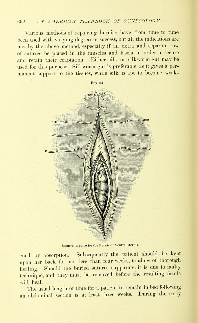 Various methods of repairing hernias have from time to time been used with varying degrees of success, but all the indications are met by the above method, especially if an extra and separate row of sutures be placed in the muscles and fascia in order to secure and retain their coaptation. Either silk or silkworm-gut may be used for this purpose. Silkworm-gut is preferable as it gives a per- manent support to the tissues, while silk is apt to become weak- Fig. 341. Sutures in place for the Repair of Ventral Hernia. ened by absorption. Subsequently the patient should be kept upon her back for not less than four weeks, to allow of thorough healing. Should the buried sutures suppurate, it is due to faulty technique, and they must be removed before the resulting fistula will heal. The usual length of time for a patient to remain in bed following an abdominal section is at least three weeks. During the early