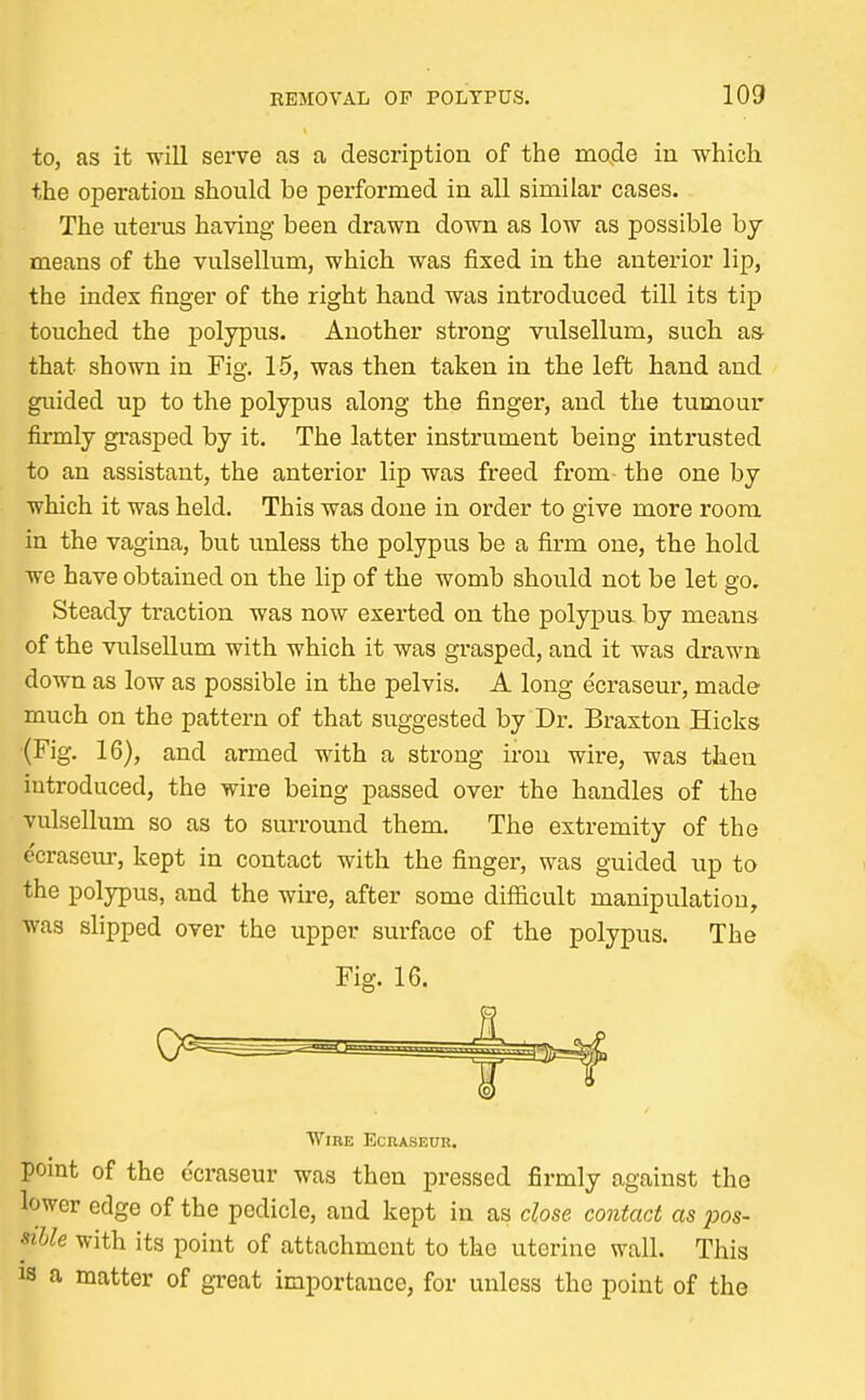 to, as it will serve as a description of the mode in which the operation should be performed in all similar cases. The uterus having been drawn down as low as possible by- means of the vulsellum, which was fixed in the anterior lip, the index finger of the right hand was introduced till its tip touched the polypus. Another strong vulsellum, such as- that shown in Fig. 15, was then taken in the left hand and guided up to the polypus along the finger, and the tumour firmly grasped by it. The latter instrument being intrusted to an assistant, the anterior lip was freed from the one by which it was held. This was done in order to give more room in the vagina, but unless the polypus be a firm one, the hold we have obtained on the lip of the womb should not be let go. Steady traction was now exerted on the polypus, by means of the vulsellum with which it was grasped, and it was drawn down as low as possible in the pelvis. A long ecraseur, made much on the pattern of that suggested by Dr. Braxton Hicks (Fig. 16), and armed with a strong iron wire, was then introduced, the wire being passed over the handles of the vulsellum so as to surround them. The extremity of the e'craseur, kept in contact with the finger, was guided up to the polypus, and the wire, after some difficult manipulation, was slipped over the upper surface of the polypus. The Fig. 16. Wire Ecraseur. point of the ecraseur was then pressed firmly against the lower edge of the pedicle, and kept in as close contact as pos- sible with its point of attachment to the uterine wall. This is a matter of great importance, for unless tho point of the