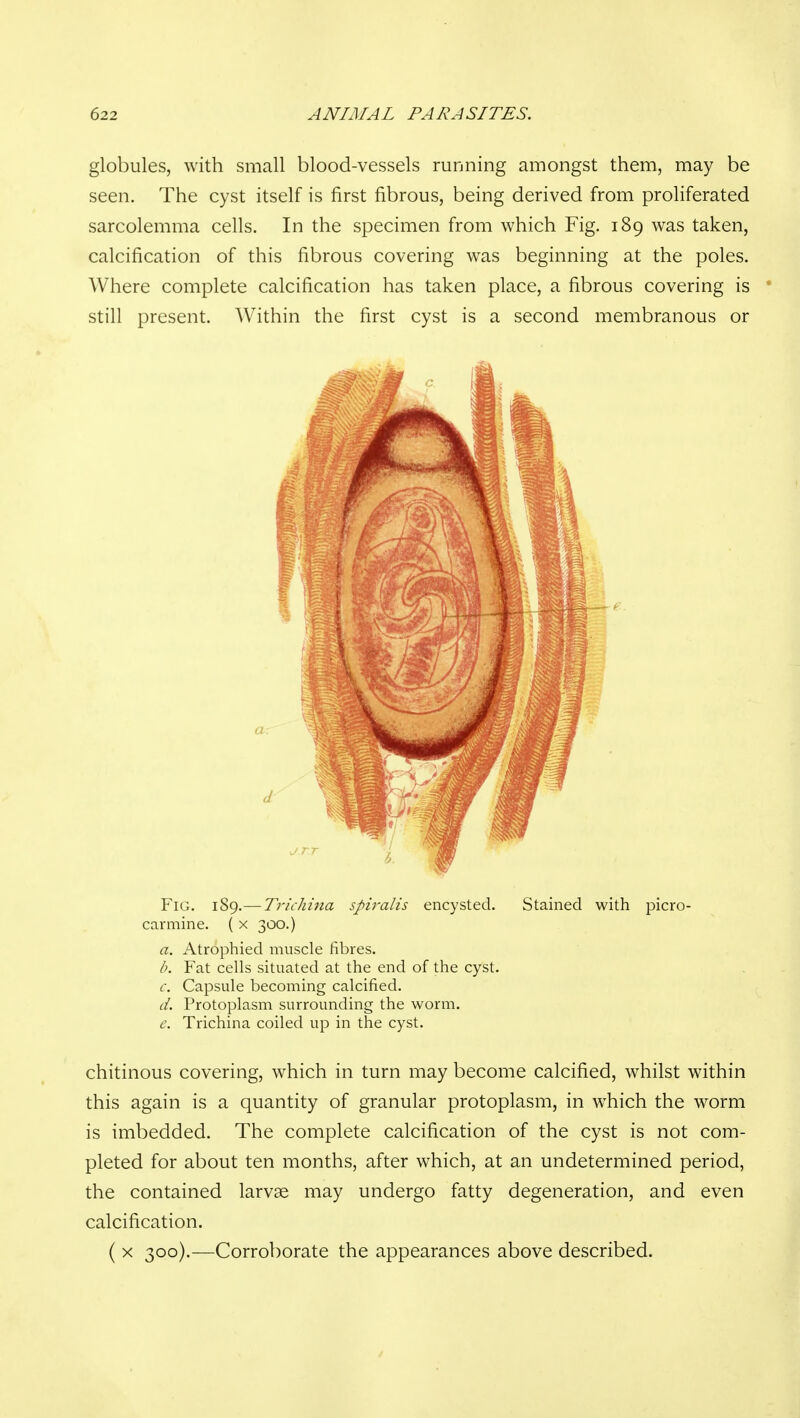 globules, with small blood-vessels running amongst them, may be seen. The cyst itself is first fibrous, being derived from proliferated sarcolemma cells. In the specimen from which Fig. 189 was taken, calcification of this fibrous covering was beginning at the poles. Where complete calcification has taken place, a fibrous covering is ' still present. Within the first cyst is a second membranous or Fig. 189.— Trichina spiralis encysted. Stained with picro- carmine. ( x 300.) a. Atrophied muscle fibres. b. Fat cells situated at the end of the cyst. c. Capsule becoming calcified. d. Protoplasm surrounding the worm. e. Trichina coiled up in the cyst. chitinous covering, which in turn may become calcified, whilst within this again is a quantity of granular protoplasm, in which the worm is imbedded. The complete calcification of the cyst is not com- pleted for about ten months, after which, at an undetermined period, the contained larvae may undergo fatty degeneration, and even calcification. ( X 300).—Corroborate the appearances above described.