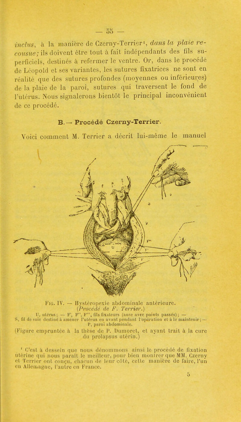 inclus, à la manière de Czemy-TerrierS dans la plaie re- co?(S?(e; ils doivent être tout à fait indépendants des fils su- perficiels, destines à refermer le ventre. Or, dans le procédé de Lcopold et ses variantes, les sutures fixatrices ne sont en réalité que des sutures profondes (moyennes ou inférieures) de la plaie de la paroi, sutures qui traversent le fond de l'utérus. Nous signalerons bientôt le principal inconvénient de ce procédé. B. — Procédé Czerny-Terrier. Voici comment M. Terrier a décrit lui-même le manuel FiG. IV. — Hysléropexie abdominale antérieure. (Procédé de F. Terrier.) V, utérus; — F', F, 1', fils fuiitciirs (anse avec points passés); — S, fil tic soie tlestiiic à amener l'ulérus en avant pciulunt l'opéralion et à le maintenir ; — 1', paroi abdominale. (Figure empruntée à la thèse do I'. Uiimorct, et ayant trait à la cure du prolapsus utérin.) ' (l'est iï dessein que nous dénommons ainsi le procédé de fixation utérine qui nous parait le meilleur, pour bien monirer (|ue MM. Czerny et '{'(îrrier ont cfmçu, diacun de leur côté, cette manière de faire, l'un eu Allcuiagnc, Tautre eu France.