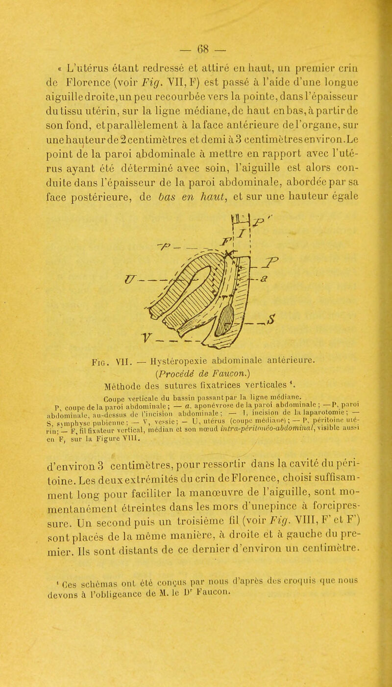 « L'ulcrus élanl redressé et alliré euliuuL, un premier eriii de Florence (voir Fig. VII, F) est passé à l'aide d'une longue aiguille droite,un peu recourbée vers la pointe, dans l'épaisseur du tissu utérin, sur la ligne médiane, de haut en bas, à partir de son fond, etparallèlement à laface antérieure del'organe, sur unehauteurdeScentimètres et demi à3 centimètresenviron.Le point de la paroi abdominale à mettre en rapport avec l'uté- rus ayant été déterminé avec soin, l'aiguille est alors con- duite dans l'épaisseur de la paroi abdominale, abordée par sa face postérieure, de bas en haut, et sur une hauteur égale Fig. VII. — Hysléropexie abdominale anléi'ieurc. [Procédé de Faucon.) Méthode des sutures fixatrices verticales Coupe verticale du bassin passant par la ligne médiane. P coupe de la paroi abdominale ; — a. aponévrose de la paroi abdominale ; —P. paroi abdominale an-dessns de l'incision abdominale; — I. incision de la laparotomie ; — S, svmphvse pubienne; - V, vessie; - U, ulériis (coupe médiane] ;- I' péritoine mé- ,.i„;_ F, iil fixateur vertical, médian et sou nœud intra-pvrxlo>wo-abdominal,y\sMc ausM en F, sur la Figure YIU. d'environ 3 centimètres, pour ressortir dans la cavité du péri- toine. Les deux extrémités du crin de Florence, choisi suffisam- ment long pour faciliter la manœuvre de l'aiguille, sont mo- mentanément étreintes dans les mors d'unepincc à forcipres- sure. Un second puis un troisième fil (voir Fig. VIII, F' et F') sont placés de la même manière, k droite et à gauche du pre- mier. Us sont distants de ce dernier d'environ un centimètre. ' Ces schémas ont été conr.us par nous d'après des croquis que nous devons à l'obligeance de M. le D' Faucon.
