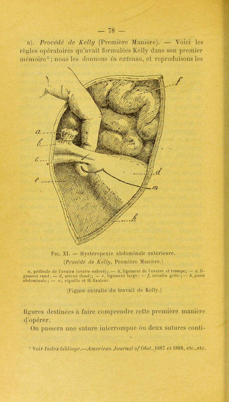 a). Procédé de Kelly (Première Manière). — Voici les règles opératoires qu'avait formulées Kelly dans son premier mémoire^ ; nous les donnons in extenso^ et reproduisons les FiG. XI. — llysléropexie abdominale antérieure. {Procédé de Kelly, Première Manière.) a, pédicule de l'ovaire (ovaire enlevé) ; — b. lif;anicnl do l'ovaire et trompe; — c. li- gament rond ;— rf, ulénis (fond); — e, ligament large; —/■, iiilesliii grêle ;—A, paroi abdominale; — iv, aiguille et fil fixateur. (Figure extraite du travail de Kelly.) figures destinées à faire comprendre cette première manière d'opérer. On passera une suture interrompue ou deux sutures conli- ' yo'iT Index biOliof/r.—American Journal ofObsl.,i&Sl et 1888, etc.,etc.