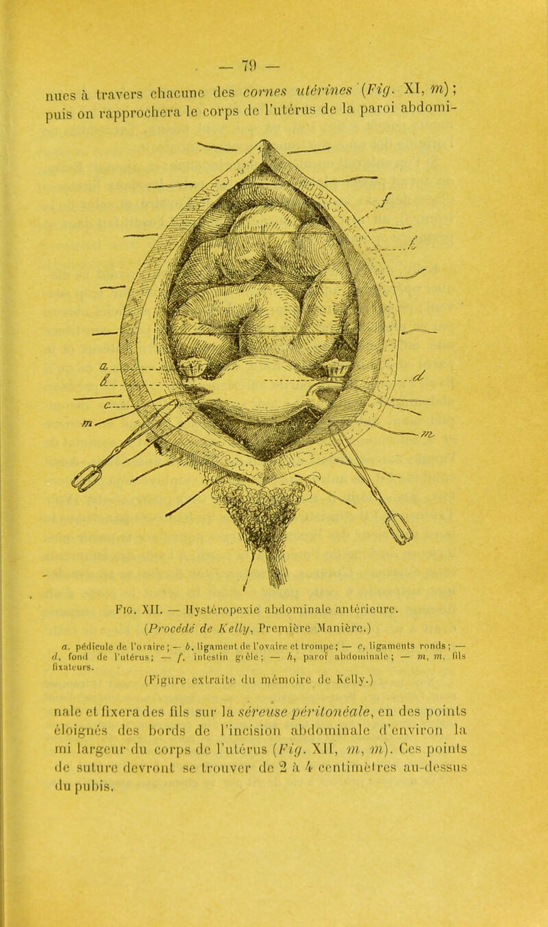 FiG. XII. — Ilystcropexie abdominale antérieure. {Procédé de Kelly, Première Manière.) a. pédicule (le l'ovaire;— é, ligament de l'ovaire et trompe; — c, ligaments ronds; — d. fonil de l'utérus; — f, intesliii gicle; — h, paroi abdominale; — m, m. fils fixateurs. (Figure extraite du mi^moire de Kelly.) nale etfixerades fils sur ]a. séreusepéritonéale, en des points éloignés des bords de l'incision abdominale d'environ la mi largeur du corps de l'uLcrns Xll, m, m). Ces poinls de suture devront se trouver de 2 il 4 centimètres au-dessus du pubis.