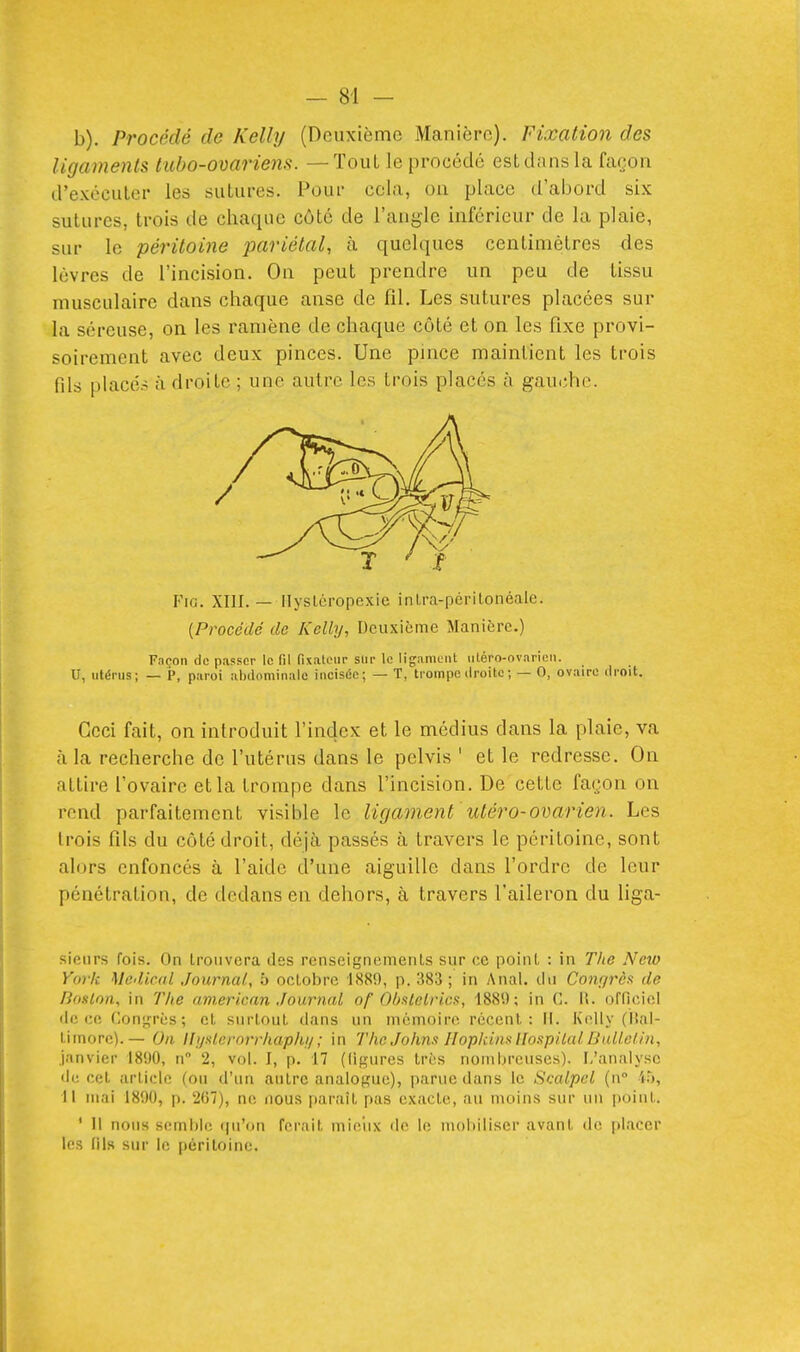 b). Procédé de Kelly (Deuxième Manière). Fixation des ligaments titbo-ovariens. — Tout le procédé estdnns la façon d'exéciiler les siiLures. Pour cela, on place d'abord six sutures, trois de chaque côté de l'angle inférieur de la plaie, sur le péritoine pariétal, à quelques centimètres des lèvres de l'incision. On peut prendre un peu de tissu musculaire dans chaque anse de fil. Les sutures placées sur la séreuse, on les ramène de chaque côté et on les fixe provi- soirement avec deux pinces. Une pmce maintient les trois fds placé.- à droite ; une autre les trois placés à gau(;he. Fia. XIII. — Ilyslcropexic inlra-périLonéale. {Procédé de Kelly, Deuxième Manière.) Façon de passer le RI fixateur slir le liganiLiil iiléro-nvarien. U, utérus; — P, paroi abilominalo incisée; — T, trompe droite ; — 0, ovaire droit. Ceci fait, on introduit l'index et le médius dans la plaie, va à la recherche de l'utérus dans le pelvis ' et le redresse. On attire l'ovaire et la trompe dans l'incision. De cette façon on rond parfaitement visible le ligament lUéro-ovarien. Les trois fils du côté droit, déjà passés à travers le péritoine, sont alors enfoncés à l'aide d'une aiguille dans l'ordre de leur pénétration, de dedans en dehors, à travers l'aileron du liga- sieiirs fois. On trouvera des renseignements sur ce point : in T)ie Neio York Médical Journal, 5 octobre 1880, p. 383 ; in Anal, du Congrès de Boslon, in The american Journal of Ohsteirics, 188!); in G. \\. officiel (le ce Con'jîPès; et surtout dans un mémoire récent: il. Kelly (Ual- timore).— On Ifi/slcrorrhaphi/; in 7'/ie John.t HopkinsUospilalBnUolin, janvier 1890, n 2, vol. I, p. 17 (ligures très nombreuses). L'analyse de cet article (ou d'un autre analogue), parue dans le Scalpel (n° 45, Il mai 1890, p. 267), ne nous paraît pas exacte, au moins sur un point. ' Il nous semble qu'on ferait miciix ilo le nu)biliser avant de placer les fils sur le péritoine.