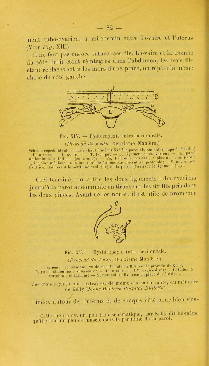 ment tubo-ovaricn, à mi-chemin entre l'ovaire et l'utérus (Voir Fig. XIIÏ). Il ne faut pas encore suturer ces fils. L'ovaire et la trompe du côté droit étant réintégrés dans l'abdomen, les trois fils étant replacés entre les mors d'une pince, on répète la même chose du côté gauche. si—^ , r * ■( ——M Fig. XIV. — Ilyslcropexic intra-périlonéale. [Procédé de Kelly, Deuxième Manière.) Schéma rcpi ésenlant, vu paren haut. Viitériis {\\é h la paroi nlxlominalc (cmipfi dii hasfin.| U. utérus: — 0, ovaire? : — T, trompe; — L, lij^ameut tubo-ovarieii : — l'a, paroi abdomiuale antériouie (en coupe); — Pe, Périloiiie pariétal, tapissant ocllc paroi: I, incision médiane de la laparotomie fermée par une «ulurc profonde; — S, une suture fixatrice, réunissant le péritoine seul (l'e) de la paroi (Pa) avec le ligamcut (L.)'- Ceci terminé, on attire les deux ligaments tubo-ovariens jusqu'à la paroi abdominale en tirant sur les six fils pris dans les deux pinces. Avant de les nouer, il est utile de promener Fie. XY. — llyatéropexie inLra-pcrilonéale. [Procédé de Kelly, Deuxième Manière.) Schéma représentant, \u de profil, l'ulérus fixé par le procédé de Kelly. P. paroi abdominale antérieure; - U. utérus: - OV. oxairc droit :-C. Colonne vertébrale et sacrum ; — S, une suture fixatrice en place du cote droit. Ces trois figures sont extraites, de même que la suivante, du mémoire de Kelly [Johns Ilopkins Hospilal Bulletin). l'index autou/de l'utérus et de chaque côté pour bien s'as- ' Cette figure est un peu trop scliémati(|ue, car Kelly (lit lui-môme qu'il prend un peu de muscle dans le péritoine de la paroi.
