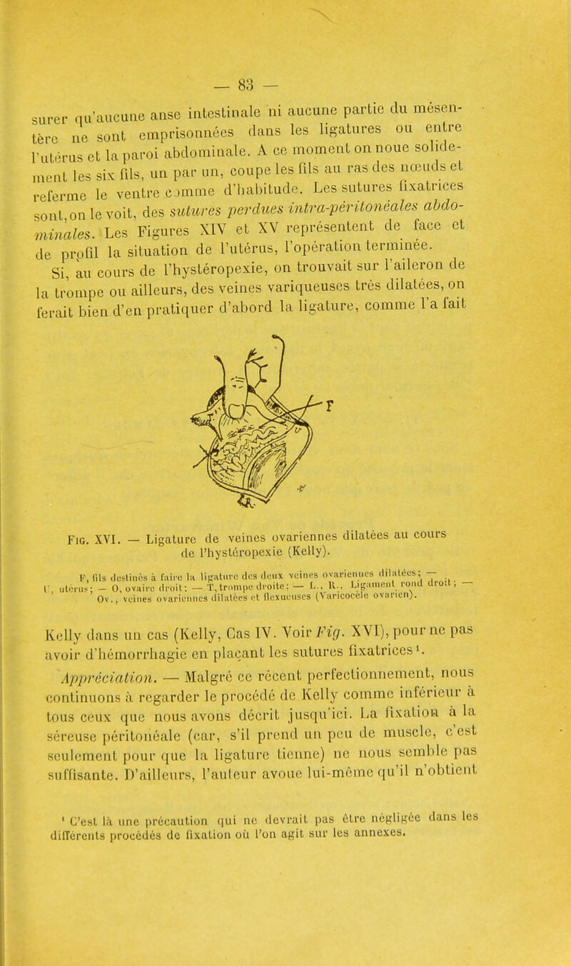 surer qu'aucune anse intestinale ni aucune partie du mésen- tère ne sont emprisonnées dans les ligatures ou entre l'utérus et la paroi abdominale. A ce moment on noue solide- ment les six fds, un par un, coupe les fils au ras des nœuds et referme le ventre CJmme d'habitude. Les sutures fixatrices sont on le voit, des sutures perdues intra-périlonéales abdo- minales. Les Figures XIV et XV représentent de face et de prpfil la situation de l'utérus, l'opération terminée. Si, au cours de l'hystéropexie, on trouvait sur l'aileron de la trompe ou ailleurs, des veines variqueuses très dilatées, on ferait bien d'en pratiquer d'abord la ligature, comme l'a fait FiG. XVI. — Ligature de veines ovariennes dilatées au cours de rhysléropexie (Kelly). F, fils dcsiinns à l'iiiro lii lisratme des .lenx veines ovai-ieniies dilatées; — V, ulorus; - 0, ovaire .Iroil; - T,tr,.mi.e droite: - L., R.. Liga.ne,.t rond droit, - Ov., veines ovariennes dilalces et Ilexuenses (Vancoeclu ovarien). Kelly dans un cas (Kelly, Cas IV. Noiv Fig. XVI), pour ne pas avoir d'hémorrhagie en plaçant les sutures fixatrices'. Appréciation. — Malgré ce récent perfectionnement, nous continuons à regarder le procédé de Kelly comme inférieur cà tous ceux que nous avons décrit jusqu'ici. La fixation à la séreuse péritoiiéale (car, s'il prend un peu de muscle, c'est seulement pour que la ligature tienne) ne nous semble pas suffisante. D'ailleurs, l'auteur avoue lui-même qu'il n'obtient ' C'est là line précaution qui no devrait pas être négligée dans les diiïérenls procédés de fixation où l'on agit sur les annexes.