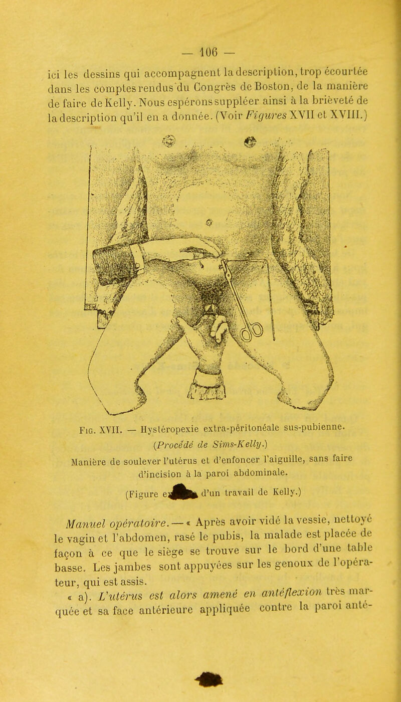 ici les dessins qui accompagnent ladcscriplion, trop écoui-tée dans les comptes rendus du Congrès de Boston, de la manière de faire de Kelly. Nous espérons suppléer ainsi à la brièveté de la description qu'il en a donnée. (Voir Figures XVII et XVIII.) FiG. XVII. — Hysléropexie extra-périlonéale sus-pubienne. {Procédé de Sims-Kelly.) Manière de soulever l'utérus et d'enfoncer Taiguille, sans faire d'incision à la paroi abdominale. (Figure e^|^|| d'un travail de Kelly.) Maymel opératoire. — ^ Après avoir vidé la vessie, nettoyé le vagin et l'abdomen, rasé le pubis, la malade est placée de façon à ce que le siège se trouve sur le bord d'une table basse. Les jambes sont appuyées sur les genoux de l'opéra- teur, qui est assis. « a). L'utérus est alors amené en antéflexion très mar- quée et sa face antérieure appliquée contre la paroi anté-