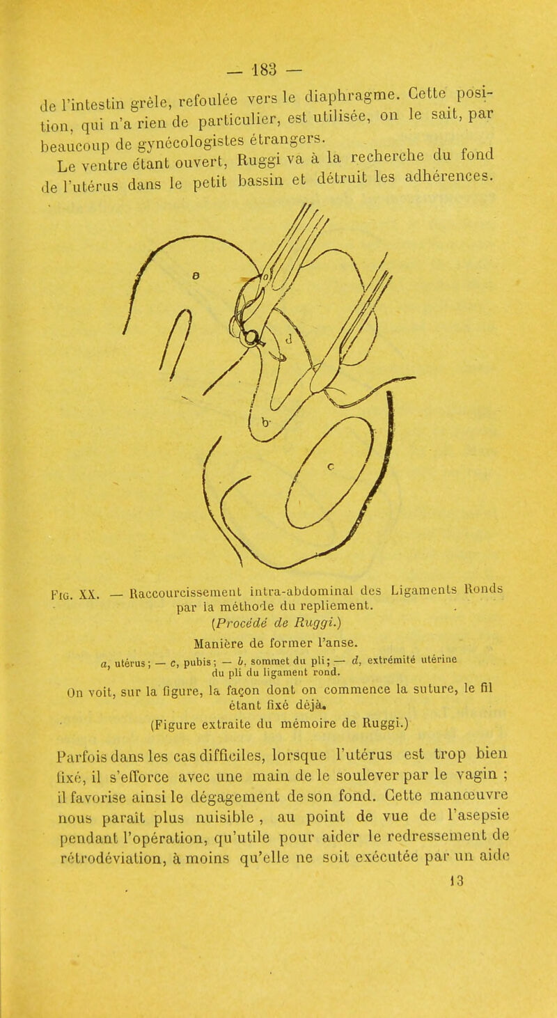 de l'intestin grêle, refoulée vers le diaphragme. Cette posi- tion, qui n'a rien de particulier, est utilisée, on le sait, par beaucoup de gynécologistes étrangers. ^ , , , , Le ventre étant ouvert, Ruggi va à la recherche du fond de l'utérus dans le petit bassin et détruit les adhérences. FiG. XX. — Raccourcissement intra-abdominal des Ligaments Ronds par ia méthode du repliement. [Procédé de Ruggi.) Manière de former l'anse. o utérus; — c, pubis; — b. sommet du pli; — d, extrémité utérine ' du pli du ligament rond. On voit, sur la figure, la façon dont on commence la suture, le fil étant fixé déjà. (Figure extraite du mémoire de Ruggi.) Parfois dans les cas difficiles, lorsque l'utérus est trop bien lixé, il s'eiïbrce avec une main de le soulever par le vagin ; il favorise ainsi le dégagement de son fond. Cette manœuvre nous paraît plus nuisible , au point de vue de l'asepsie pendant l'opération, qu'utile pour aider le redressement de rétrodévialion, à moins qu'elle ne soit exécutée par un aide 13