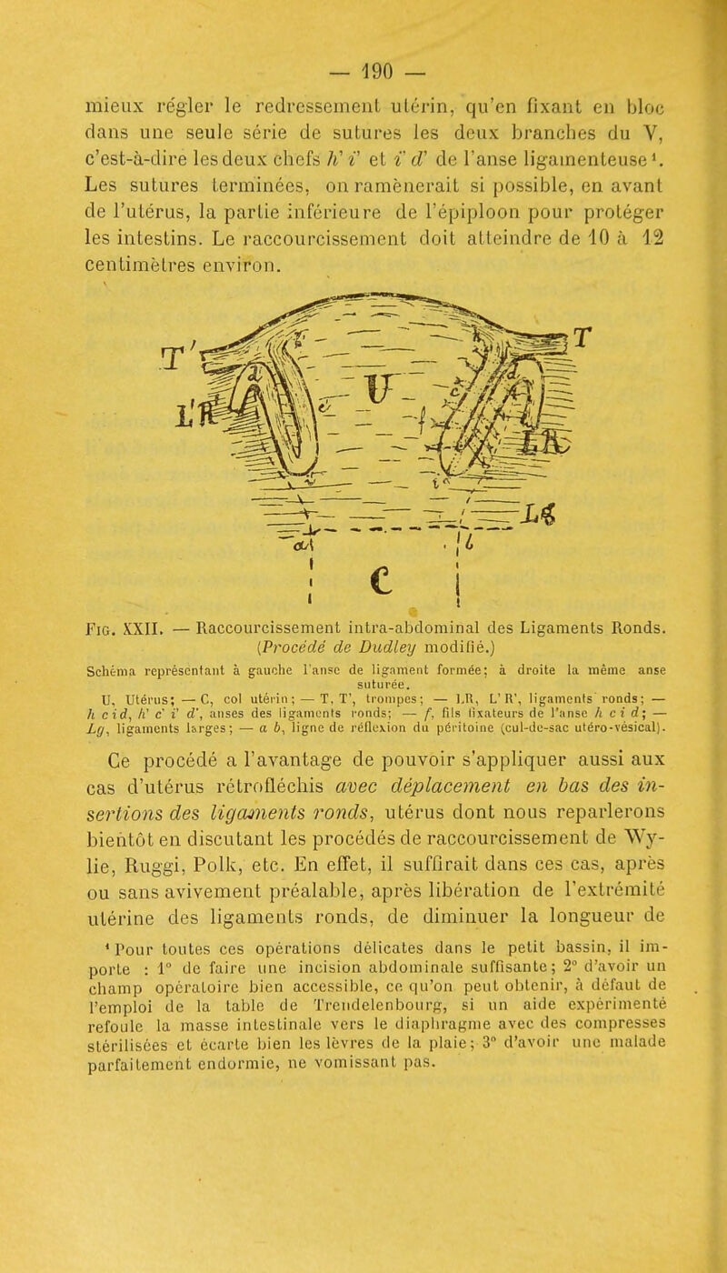 mieux régler le redressement utérin, qu'en fixant en bloc dans une seule série de sutures les deux branches du V, c'est-à-dire lesdeux chefs K i' et i cT de l'anse ligamenteuse'. Les sutures terminées, on ramènerait si possible, en avant de l'utérus, la partie inférieure de l'épiploon pour protéger les intestins. Le raccourcissement doit atteindre de 40 à 42 centimètres environ. FiG. XXII. — Raccourcissement intra-abdominal des Ligaments Ronds. [Procédé de Dudley modifié.) Schéma représcntaiil à gauche lansc de ligament formée; à droite la même anse suturée. U, Utérus; —C, col utérin; — T, T', trompes; — l.R, L'K', ligaments'ronds ; — h cid, h' c i' d', anses des ligaments ronds; — f, fils tlxateurs de l'anse h ci d; — Lg, ligaments l&rges; — ai, ligne de réflexion du péritoine (cul-de-sac utéro-vésical). Ce procédé a l'avantage de pouvoir s'appliquer aussi aux cas d'utérus rétrofléchis ariec déplacement en bas des in- sertions des ligaanents ronds, utérus dont nous reparlerons bientôt en discutant les procédés de raccourcissement de Wy- lie, Ruggi, Polk, etc. En effet, il suffirait dans ces cas, après ou sans avivement préalable, après libération de l'extrémité utérine des ligaments ronds, de diminuer la longueur de * Pour toutes ces opérations délicates dans le petit bassin, il im- porte : 1° de faire une incision abdominale suffisante; 2° d'avoir un champ opératoire bien accessible, ce qu'on peut obtenir, à défaut de l'emploi de la table de Treiidelenbourg, si un aide expérimenté refoule la masse intestinale vers le diaphragme avec des compresses stérilisées et écarte bien les lèvres de la plaie; 3 d'avoir une malade parfaitement endormie, ne vomissant pas.