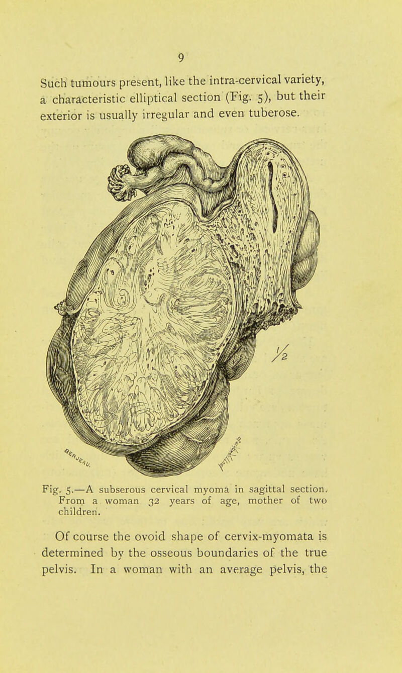 Such' tumours present, like the intra-cervical variety, a characteristic elliptical section (Fig. 5), but their exterior is usually irregular and even tuberose. Fig. 5.—A subserous cervical myoma in sagittal section^ From a woman 32 years of age, mother of two children. Of course the ovoid shape of cervix-myomata is determined by the osseous boundaries of the true pelvis. In a woman with an average pelvis, the