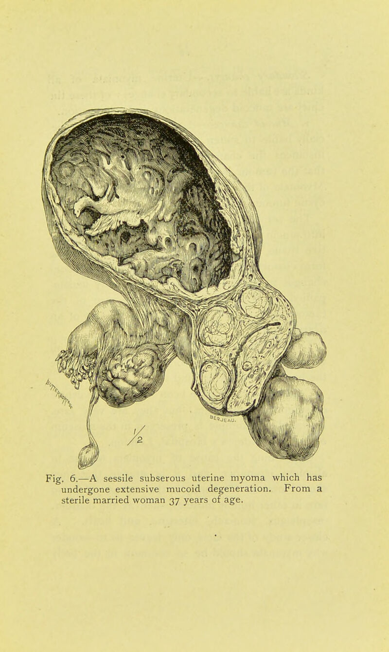 Fig. 6.—A sessile subserous uterine myoma which has undergone extensive mucoid degeneration. From a sterile married woman 37 years of age.