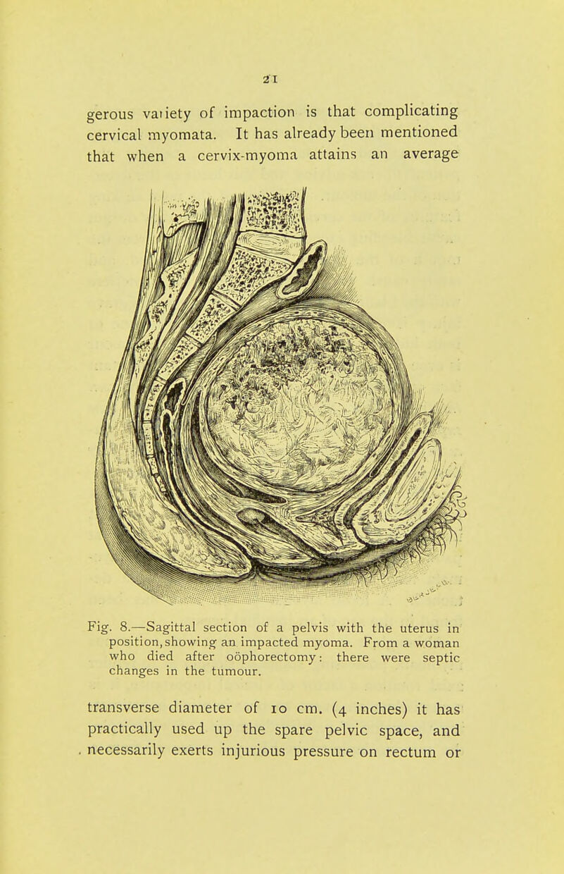 gerous vaiiety of impaction is that complicating cervical myomata. It has already been mentioned that when a cervix-myoma attains an average Fig. 8.—Sagittal section of a pelvis with the uterus in position,showing an impacted myoma. From a woman who died after oophorectomy: there were septic changes in the tumour. transverse diameter of lo cm. (4 inches) it has practically used up the spare pelvic space, and necessarily exerts injurious pressure on rectum or